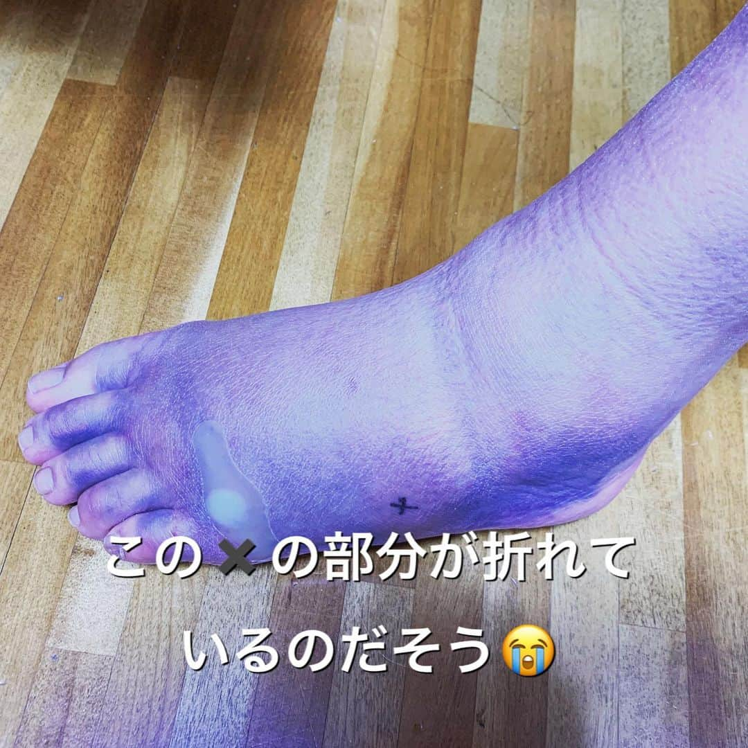 伊藤孝恵さんのインスタグラム写真 - (伊藤孝恵Instagram)「骨折した日に駆け込んだクリニックで、骨がズレていないかをチェック。私の足は相変わらず象さん🐘ですが、看護師さんに「朝生ちょっとだけ見ましたよ」と言ってもらえたり、松葉杖の使い方を院長がアツくレクチャー下さるなど、素敵な縁を骨がくれたんだわ！と嬉しい気持ちに。なーんて言ってられないほど今朝は痛い。寒いからだろうか。歩きすぎなんだろうか。  #怪我してもなお #怪我の功名 #塞翁が馬 #骨折してます #素敵なご縁 #ほっこりします #幸せ感じる #嬉しい気持ち #象さん #🐘 #ご心配おかけしてます #元気です #子育てママ #ワーママ #子供のいる暮らし #子育てあるある #子供の成長 #2児の母 #女の子ママ #Domani #ドマーニ #domanist  #伊藤たかえ #伊藤孝恵」2月2日 9時03分 - itotakae