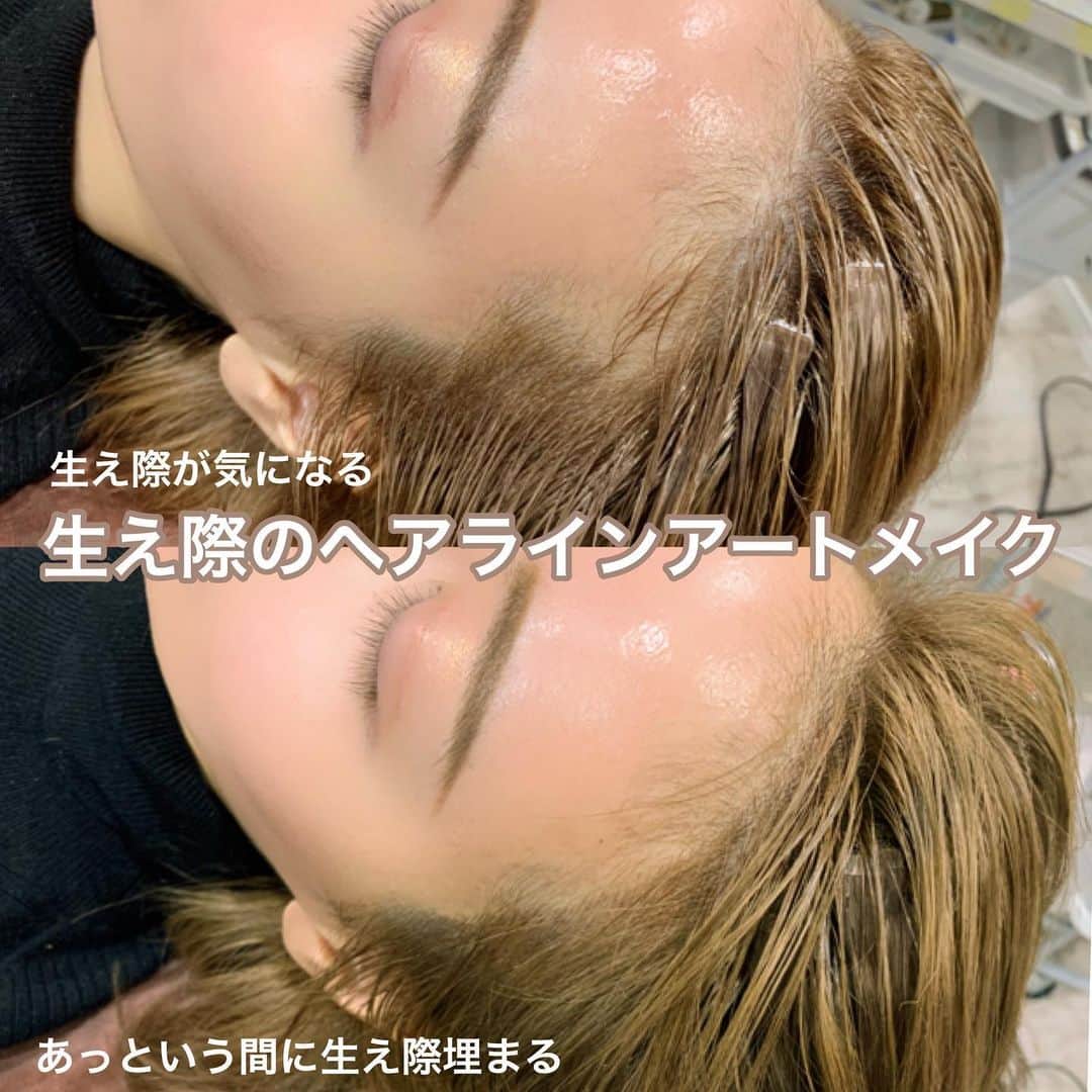 のインスタグラム：「そういえばこないだ (@medicalbrows )で ヘアラインアートメイクしたよ🥺💓 . 眉毛のアートメイクもここで 2回やったけどヘアラインも 気になったからやってみた😽💕 . やはり年齢を重ねると 生え際が気になってきて…… . ヘアラインアートメイクを 入れてみました🖐 麻酔クリームをするから 劇的な痛みもないし余裕だったよ😽💓 眉毛のアートメイクよりも 気持ち少しだけ痛い感じだけど 我慢できたから良かった!! ちなみに眉毛アートメイクの時は 爆睡してました😂💓笑 . 担当は吉田さんだよ めちゃくちゃ丁寧だった！ . #アートメイク#ヘアラインアートメイク#ヘアライン#ヘアライン仕上げ #眉アートメイク#若返り#凄い#良かった」