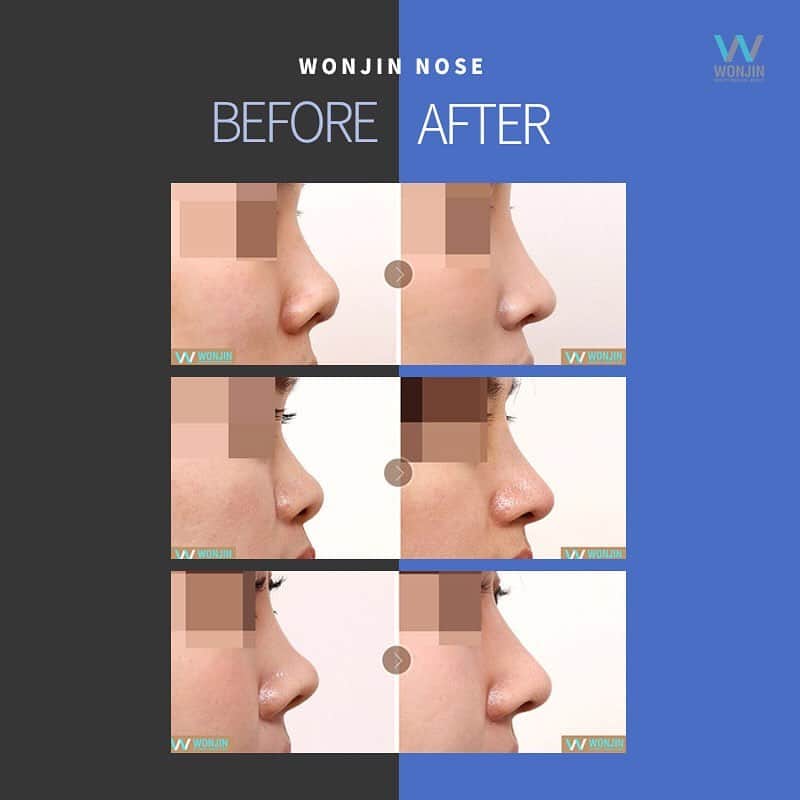 ウォンジン美容整形外科、皮膚科さんのインスタグラム写真 - (ウォンジン美容整形外科、皮膚科Instagram)「⠀ ウォンジン整形外科 ⠀ ウォンジン鼻整形👃 ⠀ 顔の中心にある鼻 その分鼻の形は顔のイメージに大きな影響を与える とても重要な部位となります✨ ⠀ ウォンジン鼻整形は 個々人の顔に合わせたオーダーメイド鼻整形で👃 自分に最も適したラインを作り出します💕 ⠀ 今なら春のイメチェン応援イベント実施中🌸 ⠀ 🔸鼻整形+埋没二重　650万ウォン 🔸鼻整形+脂肪移植　600万ウォン 🔸鼻整形+唇ヒアルロン酸　550万ウォン ⠀ イベントのお申し込み&お問い合わせはウォンジン公式ライン(@wonjin)までご連絡下さいませ📲 ⠀ (美容整形、芸能人の皮膚管理ノウハウ、アイドルのダイエット秘訣など 日本カウンセリング会予約・各種イベントについてもこちらへ💁♀✨) LINE: @wonjin SITE:jp.parkwonjin.co.kr E-mail: wonjin.jpn@gmail.com ⠀ #韓国美容整形 #韓国美容外科 #韓国整形 #整形 #美容外科 #ウォンジン #ウォンジン整形外科 #美容整形 #鼻整形 #Eライン #目整形 #二重手術 #若返り #春の応援イベント #イメチェン #新生活応援 #デビュー #イベント情報 #整形割引」2月7日 9時57分 - jp.wonjin