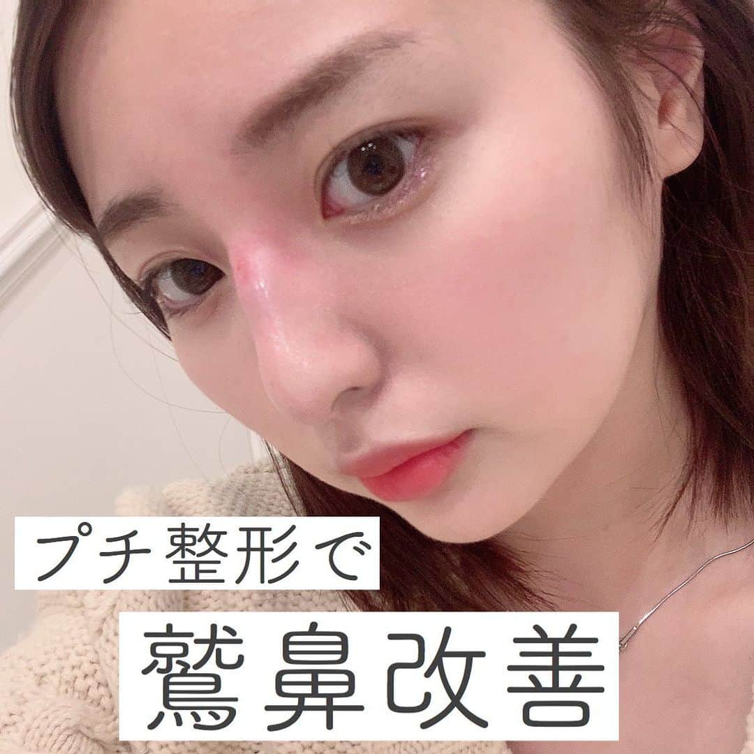 萩原うららさんのインスタグラム写真 萩原うららinstagram コンプレックスだった鷲鼻を改善すべく鼻筋にヒアルロン酸を打ったよ 本当はもう少し大がかりなやつをやろうと思ってたんだけど カウンセリングの結果 ヒアルロン酸だけで大丈夫 ってことになったの