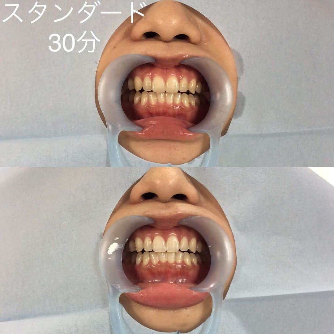 ホワイトニング専門クリニック ホワイトラボ東京 渋谷さんのインスタグラム写真 - (ホワイトニング専門クリニック ホワイトラボ東京 渋谷Instagram)「#歯のホワイトニング #歯並び 歯並びが気になる方へ  こんにちは、ホワイトラボ東京院長のスズキです。  今日は「歯並びの治し方」について考えていきたいと思います！  先日いらっしゃった方が歯並びで少し悩まれていました。正直顎の骨格的な問題はなく、少し前歯が出ている感じを矯正して治してあげれば半年強くらいで終わるかな～という程度だったのですが…。 * * ご本人としては①全部の歯をセラミックにしてセラミック矯正をする　②美容整形で顎の骨を削る手術を受ける　かの2択で考えていたようでした。  どちらも非常に究極な選択肢ですね。ですが歯の正しい知識が無いとどうしてもそういう選択肢を考えてしまうのも分かるな～と実感しました。正直①も②もどちらも初めの選択肢としてはお勧めいたしません！！ このブログでも何度もお話していますが、「自分の天然の歯を守る」ということを一番に考えていただきたいです。ご自身の歯のホワイトニングや矯正をした上でも、どうしても整形やセラミック治療をしたいということであれば止めませんが、最初の選択肢としてはちょっとオーバートリートメントです。 * *  そして歯並びを治すとき、実現不可能な歯並びには治りません。その方の顎の形や大きさに合わせて、現実的に並べられる範囲、歯を動かせる範囲でしか治療はできません。もし無理に歯を動かしすぎてしまうと「歯の神経が死んでしまう」「歯の根っこが出てきてしまう」などのトラブルが出てきてしまいます。 * *  あなたの顎骨という土台の上で、現実的に動かせる範囲で矯正を行う、これが正しい歯並びの治し方です。ホワイトラボ東京銀座院では３Dシュミレーションにより歯並びのBefore/Afterをその場でお見せすることが可能です。ただしご本人の理想の歯並びと、実際の歯並びや骨格を見たうえでどうしてもその歯並びを実現できないという場合は、申し訳ございませんが治療をお断りすることがございます。 * *  医療であっても限界があります。歯を抜歯しないとどうしても治せない症例もありますし、実際顎骨を削らないと治らない受け口などもあります。こういう場合は大学病院などに紹介状を書きますので、一度ご相談ください。でもくれぐれも気楽に歯を削ったり顎を削ったりしないでください。あとで治したくてももう後戻りできなくなってしまいますので本当に慎重にやらないといけません。 * *  歯の色も、歯並びもいつでも気楽にご相談ください！ @whitelabtokyo 銀座院ではカウンセリングはどちらに関しても無料です。 * * #ホワイトニング #オフィスホワイトニング #ホワイトニング渋谷 #ホワイトニング銀座 #歯の矯正 #マウスピース矯正 #カウンセリング無料 #銀座 #美容 #アンチエイジング #プレ花嫁 #結婚準備 #ブライダルホワイトニング #ブライダルホワイトニングならホワイトラボ東京 #美容 #メンズ美容 #自分磨き #歯を綺麗にする #セラミック #矯正 #歯並び #写真 #きれいになりたい #美活 #モデル #渋谷 #青山 #表参道」2月12日 18時10分 - whitelabtokyo