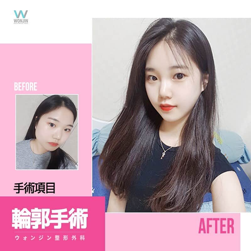 ウォンジン美容整形外科、皮膚科さんのインスタグラム写真 - (ウォンジン美容整形外科、皮膚科Instagram)「⠀ ウォンジン整形外科 ⠀ エラ手術がうまい病院🏥 ウォンジン整形外科にお任せ下さい👨‍⚕️👩‍⚕️ ⠀ 🔸シャープなライン 🔸自然なライン 🔸滑らかなライン ⠀ ご希望のフェイスラインが可能です⭕️ ⠀ 今ならエラ手術モニターモデル募集中‼️ ⠀ 🔻エラ手術🔻 モニター価格▶️385万ウォン ⠀ モニターイベントのお申し込みは必ずウォンジン公式ライン(@wonjin)までご連絡下さいませ📲 ⠀ (美容整形、芸能人の皮膚管理ノウハウ、アイドルのダイエット秘訣など 日本カウンセリング会予約・各種イベントについてもこちらへ💁♀✨) LINE: @wonjin SITE:jp.parkwonjin.co.kr E-mail: wonjin.jpn@gmail.com ⠀ #韓国美容整形 #韓国美容外科 #韓国整形 #整形 #美容外科 #ウォンジン #ウォンジン整形外科 #美容整形 #輪郭手術 #小顔整形 #Vライン #モニター募集 #モニターモデル #モデル募集 #イベント #割引イベント #整形割引 #ビフォーアフター #症例写真 #整形イベント」2月14日 10時04分 - jp.wonjin