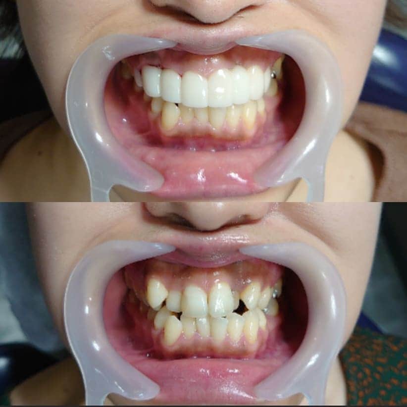 五十嵐一誠さんのインスタグラム写真 - (五十嵐一誠Instagram)「この歯と歯並びを綺麗に直しました❗  僕の直し方にセオリーとか、前例が無いから、 とかは無いです。  全てはインスピレーションとイマジネーション。  今現在の自分が持ってるスキルで何が出来るのか、 それを頭でシミュレーションの時にこの歯を こうして、この歯はこうしよう  難解なパズルをひとつひとつ解いていくように 頭の中でイメージしていくんです  実際に施術の段階でもそれは続きますし ワックス彫刻の時もです さらに 完成時にもセラミックを装着して 顔を見て、長さ、形、を削って調整しますが、 最後はお客様の好みの形と長さに合わせてます☺️ 綺麗な歯と歯並びを作るデザインで 顔の大きさ、長さ、骨格、輪郭、顎の形と長さ、 全てを考えた上で最もバランスが良く、 美しい顔になるようにデザインをイメージするのが 最も難しく これはアーティストしての才能なくしては出来ない ことです その先にあるものは それを実際に具現化するための歯科医としての 高度な技術と、それを再現するための技工士の 卓越した技能が絶対に必要になります  この歯並びは複雑ですから 向かって左側の八重歯と右側の引っ込んだ２番目の歯は 抜歯してます 抜歯した向かって右側の犬歯にジルコニアセラミッククラウンを連結して２番目の歯を作ってます  向かって左側の抜歯した八重歯は４番目の歯を 犬歯の形にして作りました  ジルコニアセラミック連結クラウン以外は 全てスーパーベニアです  料金(税抜き) ジルコニアセラミッククラウン １本 100000円 スーパーベニア １本 90000円  治療費(税抜き) 形成、型取り、仮歯、 １本 15000円  注、歯の状態によって治療費は異なります  メリット 歯科矯正では直せない歯と歯並びでもほとんど直せます  デメリット 歯を削らないと直せません  副作用 とくにありません」2月16日 10時44分 - superdentist5