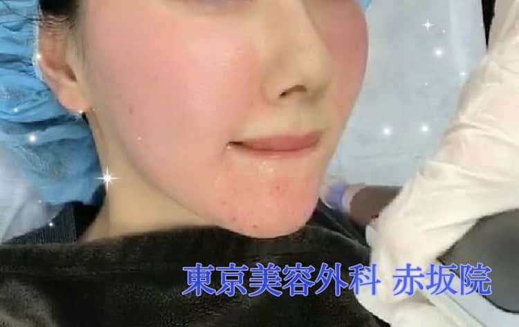 東京美容外科公式さんのインスタグラム写真 - (東京美容外科公式Instagram)「こんにちは🌷 東京美容外科赤坂院です♡  赤坂院拡大によりスキン専用フロアが誕生しました✨  流れ作業ではなく丁寧な施術を受けていただけるように、ゆとりのある予約時間を取っております❣️ 写真はヴェルベットスキン治療の様子です☺️ ヴェルベットスキンとは、ダーマペンで皮膚の表面に高密度に微小な穴をあけ、お肌の奥からハリつやを実感できるコラーゲンピールを塗布していく施術です🌟  施術直後からお肌つやピカ✨（※個人差はあります。） ⚠︎赤みや内出血、針の痛みを感じる場合がございます。  毛穴治療をしたいけど、1週間以上の長いダウンタイムが取れない方にオススメです♡  一度試してみませんか？？😘 ご予約お待ちしております🙆🏻‍♀️💓 【東京美容外科】 ====□お問い合わせはこちら□===== ▼フリーダイヤル ☎0120-658-958 （コールセンター受付時間：9：00～21：00） . ▼LINE予約 @ tkc110 =========== #東京美容外科 #東京美容外科赤坂院 #審美 #美容整形 #きれい #整形 #美活 #綺麗になりたい #美肌 #美意識 #美容外科 #アンチエイジング #ヴェルベットスキン #コラーゲンピール #ダーマペン4  #毛穴治療 #フラクショナル」2月16日 17時28分 - tokyobiyougeka_jimukyoku