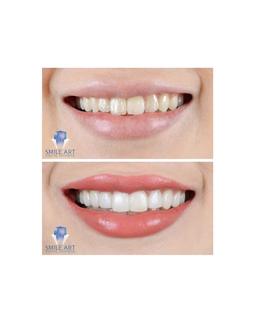 エリッサ・ヤマダさんのインスタグラム写真 - (エリッサ・ヤマダInstagram)「You can tell that I'm thrilled, but I bet you can't tell that my teeth aren't real 🤪 Yes, that's how natural Instant Veneer by @smileart.id (Dr. Ian) looks! Warna nya nggak terlalu putih, dan size nya juga nggak ketebelan jadi nggak terlihat seperti "balok", and it's super comfortable too! I've been wearing it for 2 months and I have no complaints. Swipe left to see my before-after transformation! 💫  #InstantVeneer lasts for 1-2 months (yes, I'm getting it off soon 😭), so it's suitable for those who: • are interested in getting Permanent Veneer (which is priced much higher), but still in doubt because you can't imagine how it will look on your face and you don't wanna risk it (Instant Veneer can work as your preview 😉) • only need it for a short period of time (e.g. for weddings, photoshoots, etc)  Thank you, @smileart.id, for the excellent service! And congrats on the recent opening of your new branch 💖  #smileartid #veneer #veneerjakarta #dentistjakarta #dentalaesthetic #dentalaestheticjakarta」2月17日 21時30分 - elleyamada