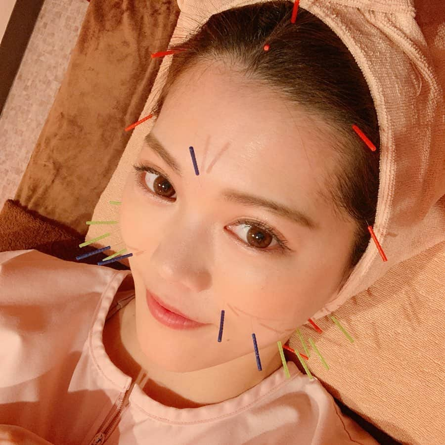 上坂由莉さんのインスタグラム写真 - (上坂由莉Instagram)「﻿ ﻿ 今日はレッスン合間に月一メンテナンス﻿ 美容鍼へ行ってきました🥰﻿ 先週は帰省してバタバタやったのもあって﻿ 脈診てもらったら打ち方が弱くお疲れ気味だったみたい😩﻿ ﻿ ﻿ 打つ前に鏡で顔見て確認したら右顎関節辺りが﻿ 左寄り下がってて😖 首こりで引っ張られて下がってたみたい💦﻿ ﻿ ﻿ なので今日の施術の流れは﻿ 脈診→脚とお腹に鍼→お顔の鍼→小顔矯正→﻿ うつ伏せで肩首、背中へ鍼という流れでした💆‍♀️﻿ ﻿ ﻿ うつ伏せでの鍼は首付け根と肩は﻿ 電気鍼にしてもらったよ❣️﻿ 肩甲骨あたりも打ってもらったので身体がスッキリ✨﻿ (ヨガウェア捻れてるのはお気になさらず😂)﻿ 身体やらかいのに凝るから厄介だー😭❗️﻿ ﻿ ﻿ 終わったらしっかり左右の顎関節の位置も揃って﻿ フェイスラインもキュッと上がって 輪郭ぼやけてたのがくっきりになった😍﻿ Before 3枚目、After 4枚目📸 １年以上継続してだいぶ戻りが少なくなったよ💆‍♀️﻿ ﻿ ﻿ 東洋医学やツボ等はヨガとも通じる部分が沢山で﻿ 施術中も美容のお話が沢山できて楽しい💓﻿ 今日もありがとうございました🥰﻿ @sbc.tokyo﻿ ﻿ ﻿ #世田谷ビューティークリニーク #鍼灸治療院 #鍼灸﻿ #美容鍼 #小顔矯正 #世田谷 #池尻大橋﻿」2月18日 18時39分 - yuri_yoga.727