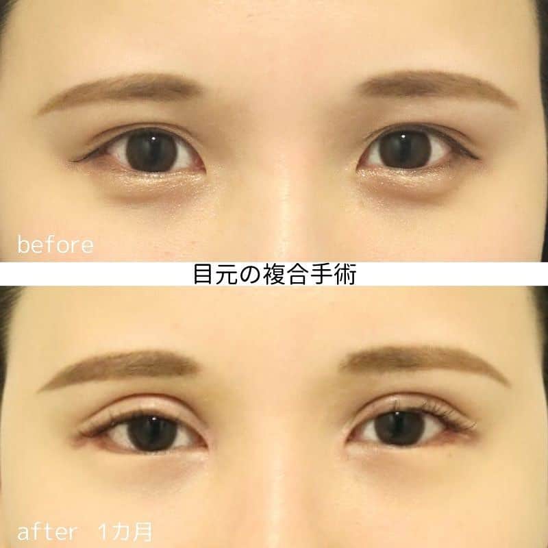 のインスタグラム：「複合手術で理想の目元に👀✨﻿ ﻿ ＼イセアで叶える理想の目元／﻿ ﻿ 👨🏻‍⚕️執刀医:ヨシタネ　@yoshitane_isea ﻿ ﻿ ☑︎目頭切開﻿ ☑︎全切開﻿ ☑︎目尻切開﻿ ☑︎下眼瞼下制﻿ ﻿ の複合手術から1ヶ月の様子です👀💡﻿ ﻿ 写真上:before ﻿ 写真下:after 1カ月﻿ ﻿ ﻿ 大きな腫れや内出血は引きましたが、﻿ まだ腫れが残っている状態です👨🏻‍⚕️﻿ ﻿ これから少しずつ腫れは落ち着いていきます。﻿ 完成は3ヶ月です✨✨﻿ ﻿ ﻿ ▼▼▼▼▼▼▼▼▼▼﻿ ﻿ ﻿ 【イセアの目元の手術は】﻿ ①埋没法から切開法まであらゆる手術ができる医師が担当﻿ ②笑気麻酔を追加することができる﻿ ③サングラスやタクシーチケットのお渡しが可能﻿ ﻿ ﻿ ﻿ 😣後の痛み: 数日﻿ ⚠️腫れ・内出血・赤み: 1〜2週間程度﻿ ⚠️左右差・瘢痕のリスク﻿ 👨‍⚕️抜糸:5〜7日後﻿ 👛目頭切開¥212800﻿ 👛全切開¥298000﻿ 👛目尻切開¥212800﻿ 👛下眼瞼下制¥318800﻿ （全て税別) ※同時割引がございます※﻿ ﻿ カウンセリングは無料です💁🏼‍♀️💁🏼‍♂️﻿ お気軽にご来院下さい👩🏻‍⚕️️✨﻿ ﻿ ﻿ ﻿ #銀座#ginza #shibuya #渋谷﻿ #iseaclinic#イセアクリニック#イセア﻿ #美容整形#美容外科#美容皮膚科﻿ #吉種克之 #埋没#埋没法﻿ #プチ整形#目頭切開 #全切開#目尻切開 #たれ目形成 #下眼瞼下制 ﻿ #二重 #アイプチ #モニター募集 ﻿ #綺麗になりたい#可愛くなりたい」
