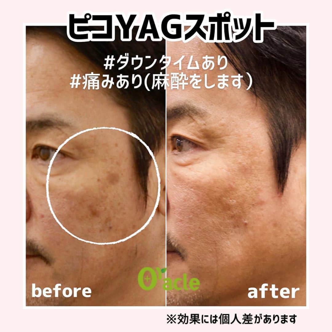 オラクル美容皮膚科東京新宿院さんのインスタグラム写真 - (オラクル美容皮膚科東京新宿院Instagram)「シミ治療▶︎ピコYAGスポット﻿ ﻿ ピコYAGレーザーによるシミ治療は、お顔全体に照射するトーニングやルメッカ（IPL）と違い、目立つシミをピンポイントで照射し、1回でシミを取る治療です。﻿ ﻿ ※回数には個人差があります。﻿ ﻿ ※写真の男性はピコスポット1回で、ほぼシミはなくなりましたが、まだ薄く残っている箇所があるため3ヶ月後に2回目治療予定です。﻿ ﻿ ▪️▫️▪️▫️▪️▫️▪️▫️▪️▫️﻿ ﻿ ピコYAGは強いレーザーのため、施術間隔は長くとっていただきます。﻿ ﻿ 💰料金﻿ ✔️100円玉基準　1回　¥25,000（税抜）﻿ ✔️全顔　¥98,000（税抜）﻿ ﻿ ⏰ダウンタイム﻿ 施術後シミが浮き上がり瘡蓋になります。﻿ 1週間肌色のテープを貼ってすごします。﻿ テープの上からメイク可能です。﻿ 瘡蓋は1週間〜10日かけて自然にはがれます。﻿ ﻿ ⚠️リスクなど﻿ 施術中痛みがありますので、麻酔をして施術を行います。﻿ ﻿ 📷症例　40代男性﻿ ルメッカ3回﻿ ピコYAGレーザー　1回﻿ ﻿ ※ルメッカで顔全体とトーンUPとシミを薄くする治療後にピコスポット照射﻿ ﻿ ▪️▫️▪️▫️▪️▫️▪️▫️▪️▫️﻿ ﻿ ダウンタイムが気になる方は﻿ 連休など長めにお休みが取れる時におすすめです。﻿ ﻿ ▪️▫️▪️▫️▪️▫️▪️▫️▪️▫️﻿ ﻿ 🇯🇵オラクル美容皮膚科🇰🇷﻿ 📍新宿3丁目19-4 MLJ新宿8階﻿ ﻿ 【専門】﻿ ニキビ（跡）／毛穴／シミ／しわ／たるみ／痩身／アンチエイジング／美白美肌全般／ブライダル相談／メンズ美容﻿ ﻿ 🗝完全予約制﻿ 👠土日祝日も診療﻿ ﻿ 【予約方法】﻿ ☎0120-905-696﻿ ⏰9:00～21:00［年中無休］﻿ ﻿ LINE、メール24時間📧﻿ LINE🆔 @oracle.jp ﻿ 📩HPメールフォームよりお願いいたします﻿ ﻿ ▪️▫️▪️▫️▪️▫️▪️▫️▪️▫️﻿ #オラクル美容皮膚科 #オラクル ﻿ #oracle #美容皮膚科 #男のシミ #皮膚管理 ﻿ #ルメッカ #シミ #そばかす #赤ら顔 #ツヤ肌 #トーンアップ #ipl #老け肌 #韓国美容 #メンズ美容 #일본피부과 #신주쿠 #도쿄 #오라클피부과﻿ #美容男子　#ピコレーザー　#YAGレーザー　#ピコスポット　#ピコYAGレーザー　#シミ治療　#シミ取り」3月19日 9時05分 - oraclejp