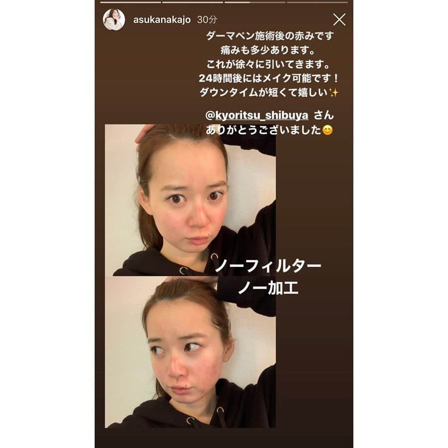 共立美容外科・歯科・皮膚科さんのインスタグラム写真 - (共立美容外科・歯科・皮膚科Instagram)「ありがとうございました❤️ またお待ちしてます😉 @asukanakajo ・ #共立美容外科 #共立美容外科渋谷院 #ビジネスクリック #中城あすか #タレント #モデル #芸能人御用達 #ダーマペン #ダーマペン4 #ヴァンパイアフェイシャル #ニキビ跡改善 #にきび跡改善 #ニキビ跡ケア #ニキビ跡 #毛穴改善 #毛穴の開き改善 #肌質改善 #美肌効果抜群」3月19日 13時19分 - kyoritsu_biyo