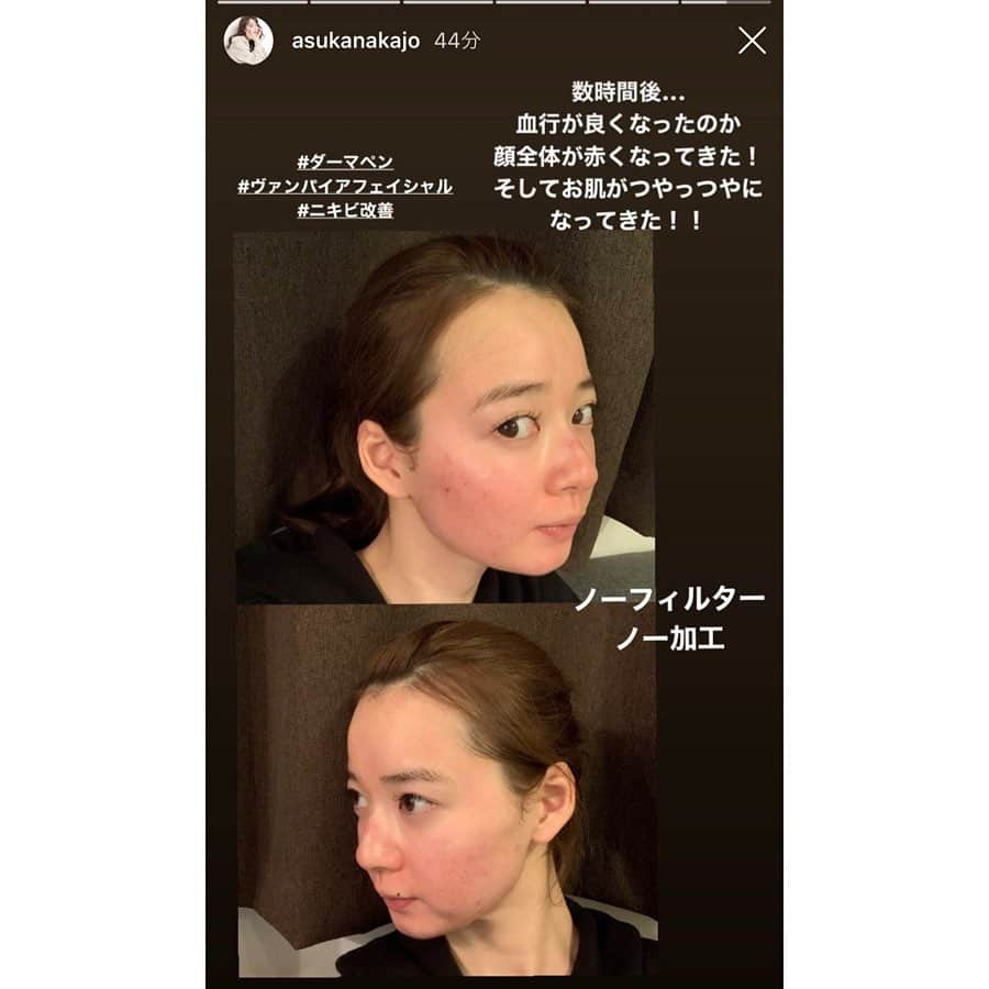 共立美容外科・歯科・皮膚科さんのインスタグラム写真 - (共立美容外科・歯科・皮膚科Instagram)「ありがとうございました❤️ またお待ちしてます😉 @asukanakajo ・ #共立美容外科 #共立美容外科渋谷院 #ビジネスクリック #中城あすか #タレント #モデル #芸能人御用達 #ダーマペン #ダーマペン4 #ヴァンパイアフェイシャル #ニキビ跡改善 #にきび跡改善 #ニキビ跡ケア #ニキビ跡 #毛穴改善 #毛穴の開き改善 #肌質改善 #美肌効果抜群」3月19日 13時19分 - kyoritsu_biyo