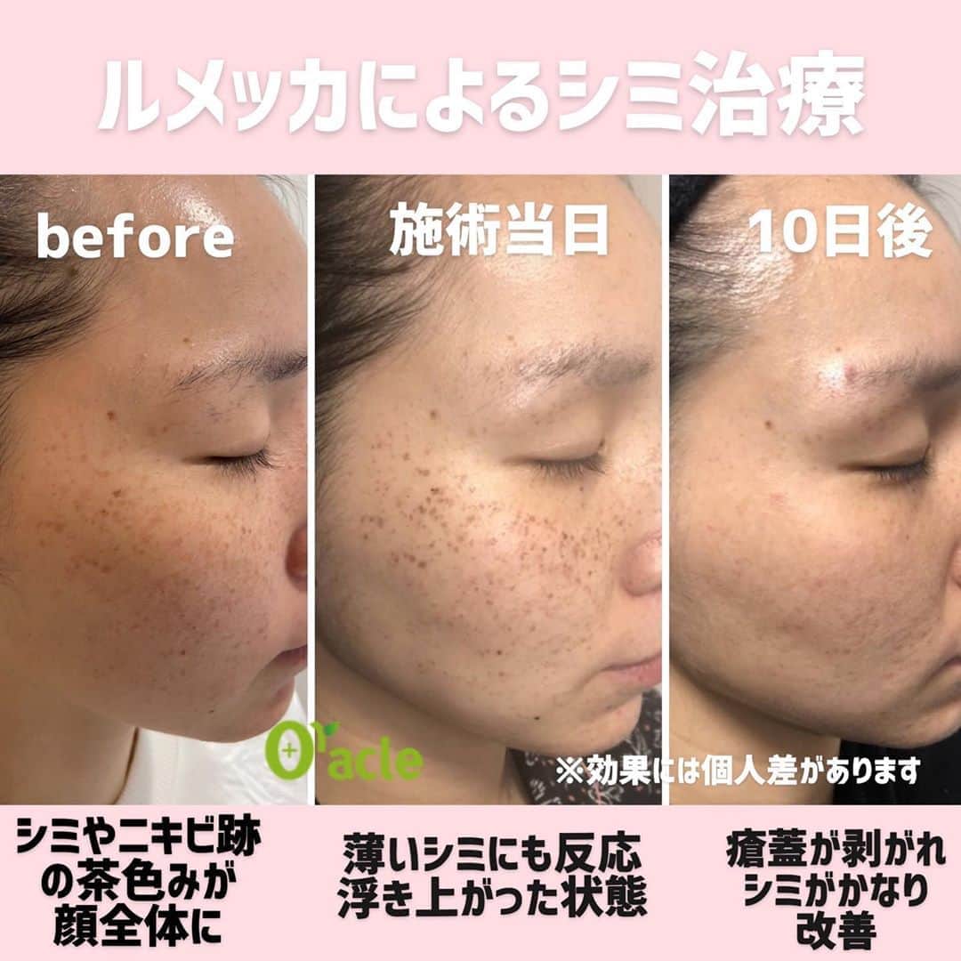 オラクル美容皮膚科東京新宿院さんのインスタグラム写真 - (オラクル美容皮膚科東京新宿院Instagram)「ニキビ跡で顔全体に茶色みがあった﻿ 20代女性です﻿ ﻿ かなり反応の良いパターンです。﻿ 1回目のルメッカで顔全体のシミが浮き上がり﻿ 約10日かけて剥がれ落ちました。﻿ ﻿ 反応した瘡蓋は薄く、一時的にシミが濃くなったかな？﻿ 程度なので普段通りメイクも可能です。﻿ ﻿ ୨୧┈┈┈┈┈┈┈┈┈┈┈┈┈┈┈┈┈୨୧﻿ ﻿ お肌のくすみも気になるとのことで、こちらの方は3回治療予定です。﻿ ﻿ ルメッカは美白効果も期待できます。﻿ ﻿ #IPL #フォトフェイシャル　#光治療法﻿ ﻿ ୨୧┈┈┈┈┈┈┈┈┈┈┈┈┈┈┈┈┈୨୧﻿ ﻿ 【料金】﻿ ☑️トライアル　顔全体　25,000円（税抜）﻿ ☑️通常　顔全体　30,000円（税抜）﻿ ﻿﻿ ﻿ ୨୧┈┈┈┈┈┈┈┈┈┈┈┈┈┈┈┈┈୨୧﻿ ﻿ ⚠️リスク　⏰ダウンタイム﻿ ﻿ 麻酔なしの施術　ゴムで弾かれたような痛み程度﻿ ほてりや赤みが出た場合も数時間でおさまります。﻿ 薄い瘡蓋程度が1週間（メイク可能）﻿ テープ貼りは不要﻿ ﻿ ୨୧┈┈┈┈┈┈┈┈┈┈┈┈┈┈┈┈┈୨୧﻿ ﻿ ルメッカ人気のためご予約取りにくくなっております。﻿ 余裕をもってご予約、ご来院のほどよろしくお願いします。﻿ ﻿ ﻿ ▪️▫️▪️▫️▪️▫️▪️▫️▪️▫️﻿ ﻿ 🇯🇵オラクル美容皮膚科🇰🇷﻿ 📍新宿3丁目19-4 MLJ新宿8階﻿ ﻿ 【専門】﻿ ニキビ（跡）／毛穴／シミ／しわ／たるみ／痩身／アンチエイジング／美白美肌全般／ブライダル相談﻿ ﻿ 🗝完全予約制﻿ 👠土日祝日も診療﻿ ﻿ 【予約方法】﻿ ☎0120-905-696﻿ ⏰9:00～21:00［年中無休］﻿ ﻿ LINE、メール24時間📧﻿ LINE🆔 @oracle.jp ﻿ 📩HPメールフォームよりお願いいたします﻿ ﻿ ﻿ #オラクル美容皮膚科  #シミ #肝斑 #そばかす #シミ取り #シミケア #シミ対策 #美肌 #美肌ケア #美肌作り #美肌になりたい #美肌効果 #美白ケア #美白効果 #トーンアップ  #美容皮膚科 #美容 #美容好き #美容部 #美容好きな人と繋がりたい #美容好き #韓国美容 #韓国 #美容オタク　#ルメッカ　#ピコレーザー　#ピコトーニング」3月20日 9時45分 - oraclejp