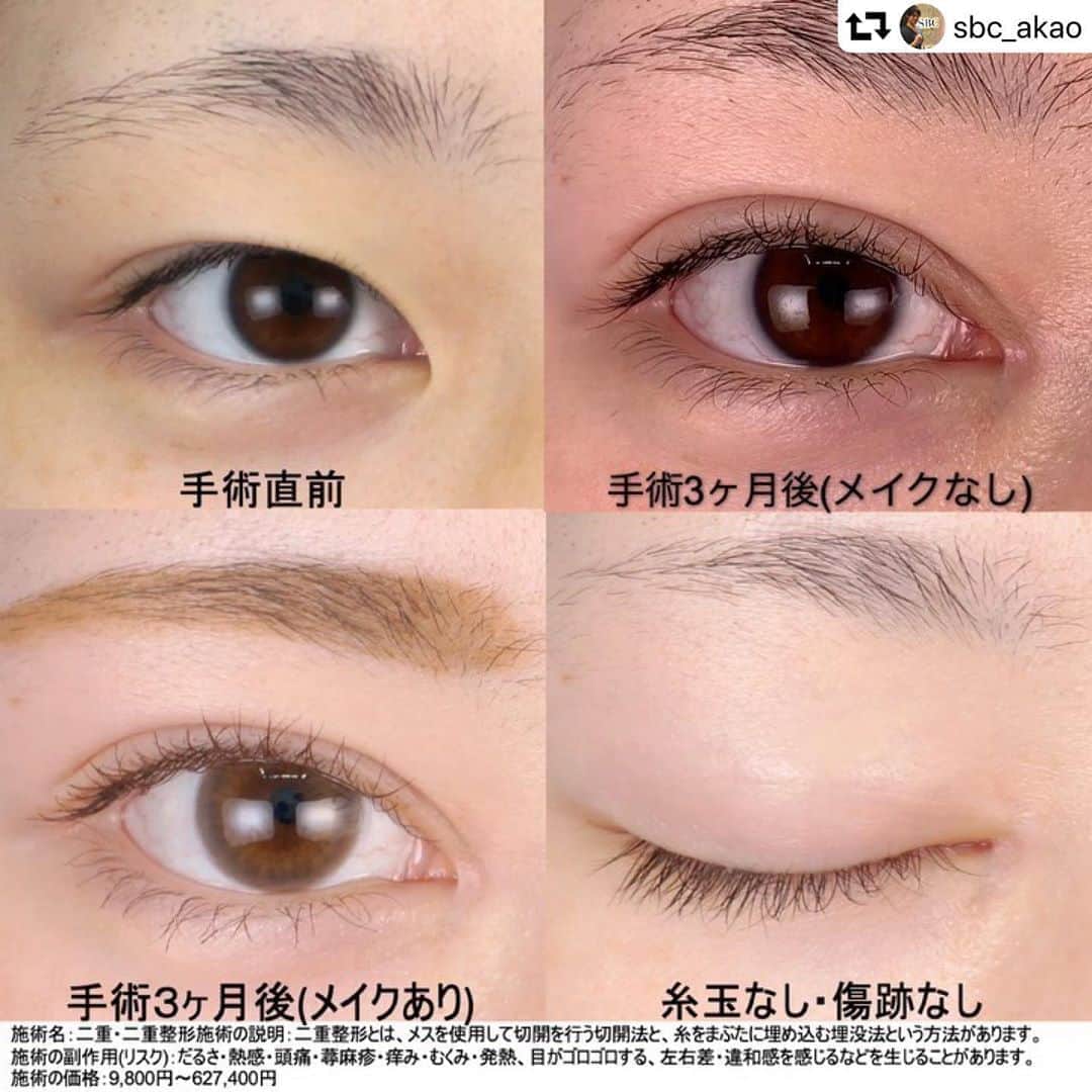 湘南美容外科 柏院さんのインスタグラム写真 湘南美容外科 柏院instagram この画像の続きをご覧になりたい方は タグ付けされている赤尾院長のインスタグラム Sbc Akao へgo 毎日ご指名殺到