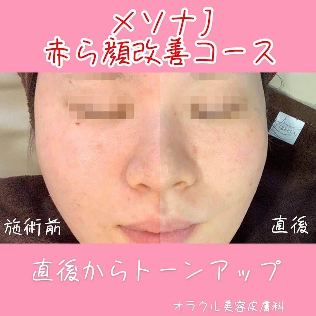 オラクル美容皮膚科東京新宿院さんのインスタグラム写真 - (オラクル美容皮膚科東京新宿院Instagram)「メソナJ 『赤ら顔改善コース』のご紹介﻿ 男性にもおすすめ‼️﻿ ﻿ 赤ら顔コースの主な成分は﻿ 【ビタミンB12】﻿ ﻿ ビタミンB12は皮膚の再生効果が高く﻿ 肌質を根本から改善‼️﻿ ﻿ ✅メイクで隠すのが難しい【赤ら顔】﻿ ﻿ ✅頬の赤みが悩みの男性﻿ ﻿ ✅目の下のくま改善﻿ ﻿ ✅肌トーンアップ、美白効果﻿ ﻿ ✅アトピー肌﻿ ﻿ これらの効果が期待できます⤴️﻿ ﻿ 男性でも赤ら顔に悩む方はとても多く、男性はメイクで隠せないので特に気にされる方が多いです😅﻿ ﻿ そんな方にぜひメソナJの赤ら顔改善コースをお試しいただきたいです👆﻿ ﻿ 赤ら顔改善コースは、アトピーの方や目の下クマにも効果的です。﻿ ﻿ ▪️▫️▪️▫️▪️▫️▪️▫️▪️▫️﻿ ﻿ 【メソナJ料金】！トライアル実施中！﻿ 4つのコースをご用意しました👏﻿ ﻿ ①赤ら顔改善コース﻿ ※赤ら顔、アトピー性皮膚炎、眼下のくま﻿ 顔トライアル 14,400円﻿ ﻿ ②ニキビ撃退コース﻿ ※ニキビ、毛穴﻿ 顔トライアル 20,000円﻿ ﻿ ③美白肌コース﻿ ※肝斑、美白、くすみ、シミ﻿ 顔トライアル 20,800円﻿ ﻿ ④トータルアンチエイジングコース﻿ ※たるみ、アンチエイジング、美白、肝斑、シミ、毛穴﻿ 顔トライアル 24,000円﻿ ﻿ 💎オプションで成分追加も1,000円〜﻿ ﻿ ※上記は税抜き価格となります。﻿ ﻿ ▪️▫️▪️▫️▪️▫️▪️▫️▪️▫️ ﻿ ﻿ ﻿ ※コースはご来院後に決めていただいても大丈夫です🙆‍♀️﻿ ﻿ ご予約お待ちしております😊﻿ ﻿ ▪️▫️▪️▫️▪️▫️▪️▫️▪️▫️﻿ ﻿ 🇯🇵オラクル美容皮膚科🇰🇷﻿ 📍新宿3丁目19-4 MLJ新宿8階﻿ ﻿ 【専門】﻿ ニキビ（跡）／毛穴／シミ／しわ／たるみ／痩身／アンチエイジング／美白美肌治療全般﻿ ﻿ 🗝完全予約制﻿ 👠土日祝日も診療﻿ ﻿ 【予約方法】﻿ ☎0120-905-696﻿ ⏰9:00～21:00［年中無休］﻿ ﻿ LINE、メール24時間📧﻿ LINE🆔 @oracle.jp ﻿ 📩HPメールフォームよりお願いいたします﻿ ﻿ ▪️▫️▪️▫️▪️▫️▪️▫️▪️▫️﻿ ﻿ #美容 #美容皮膚科 #イオン導入 #ヒト幹細胞 #幹細胞 #ニキビ改善 #ニキビ治療 #ヒアルロン酸 #コエンザイムQ10 #赤ら顔 #アンチエイジング #若返り #毛穴 #アトピー改善 #肝斑治療 #シミ治療 #美白ケア #美容オタク #美容マニア #美容マニア御用達 #美容好きな人と繋がりたい #美容好き #美容好きさんと繋がりたい　#韓国美容　#韓国美容皮膚科」2月26日 9時12分 - oraclejp
