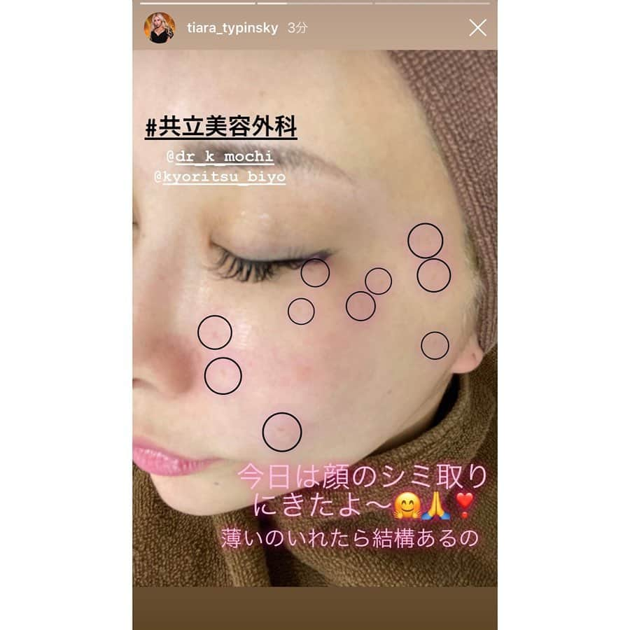 共立美容外科・歯科・皮膚科さんのインスタグラム写真 - (共立美容外科・歯科・皮膚科Instagram)「ありがとうございました🎉 またお待ちしてます😘 @tiara_typinsky ・ #共立美容外科 #共立美容外科渋谷院 #芸能人御用達 #dj #TIARA #パリピ #パリピ女子 #qスイッチレーザー #qスイッチyagレーザー #qスイッチヤグレーザー #しみ取り #シミ取り #しみ取りレーザー #シミ取りレーザー #シミ対策 #シミケア #しみ治療 #シミ治療 #美肌 #美肌ケア #レーザー治療」2月28日 11時44分 - kyoritsu_biyo