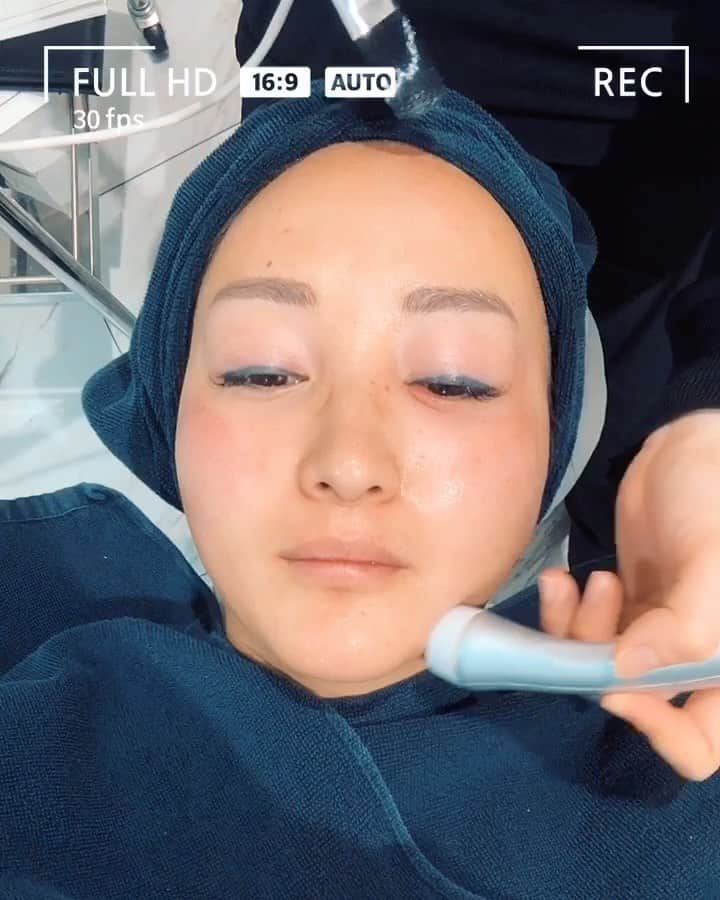 木村真野のインスタグラム：「@tokyo_hills_clinic 行ってきました✨ ピーリングしてレーザートーニングして 最後にしっかり美肌トリートメントしてもらった✨行く度に綺麗な肌になって本当に嬉しい🥺杉浦院長もスタッフ方も優しくて美肌になるためにしっかり悩みを聞いてくれる👨‍🏫 一緒に考えて一人一人に合ったメニューを選んでくれる🥰 33歳は東京ヒルズクリニックの力をお借りして人生初の美白&美肌を目指します🤪❤️✨ #東京ヒルズクリニック #美肌 #美白 #ピーリング #レーザートーニング #美肌トリートメント」