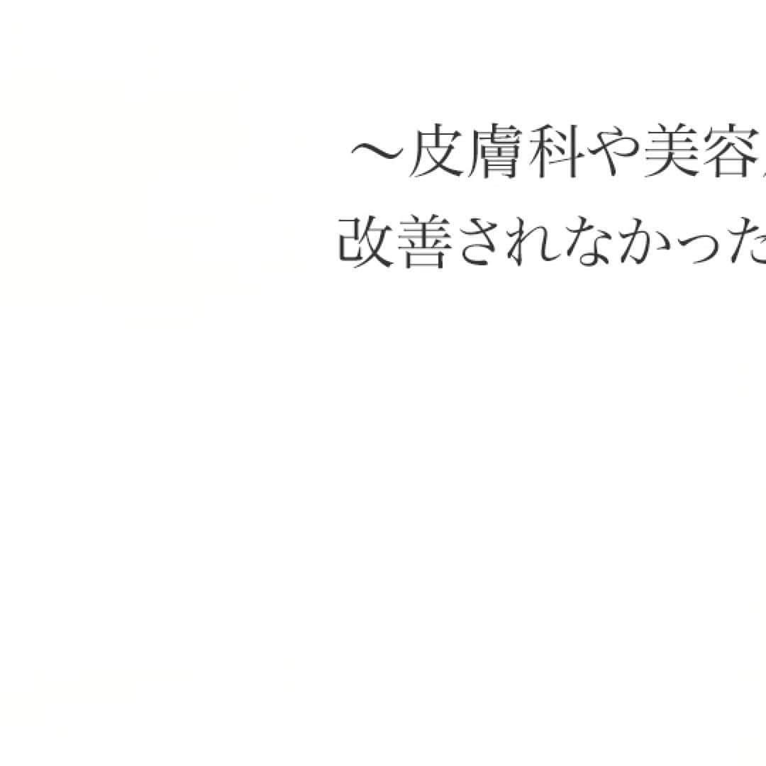 さんのインスタグラム写真 - (Instagram)「#ニキビ #ニキビ跡 #クレーター #ニキビケア #ニキビ専門サロン #皮膚科 #美容外科 #美容皮膚科 #スキンケア #韓国 #横浜 #広尾 #コメド #白ニキビ #赤ニキビ #大人ニキビ #吹き出物 #色素沈着 #ハーブピーリング #ケミカルピーリング #イオン導入 #ヒト幹細胞 #ビタミンc #プラセンタ #成長因子 #ダーマペン #フラクショナルco2レーザー #フォトフェイシャル #水光肌 #ツヤ肌」3月1日 18時21分 - hanae_krizzia