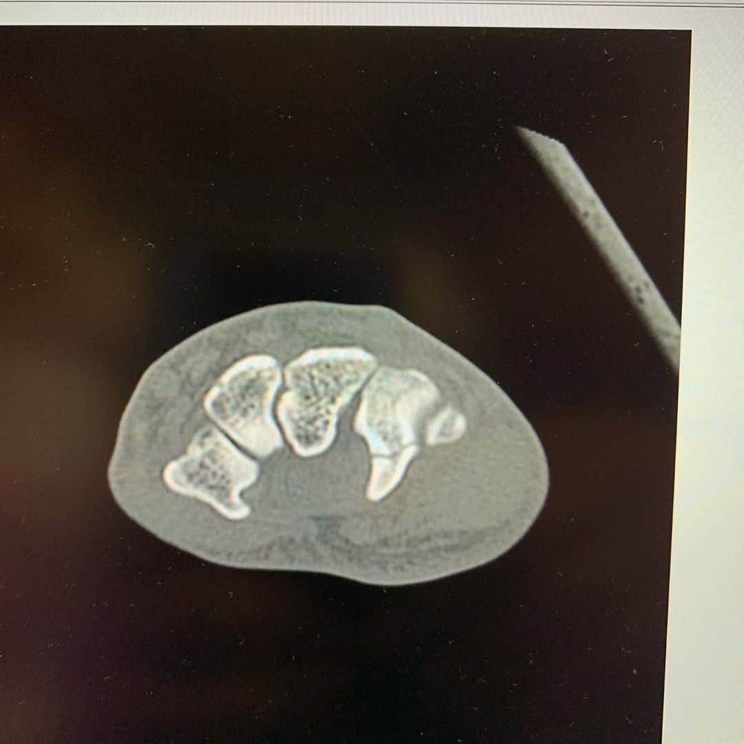立岡宗一郎さんのインスタグラム写真 - (立岡宗一郎Instagram)「有鈎骨。折れた骨片を摘出する手術を受けます。こわいこわい😱😱 #有鈎骨#局部麻酔#日帰り手術#初手術」3月2日 21時53分 - ta_pi_39