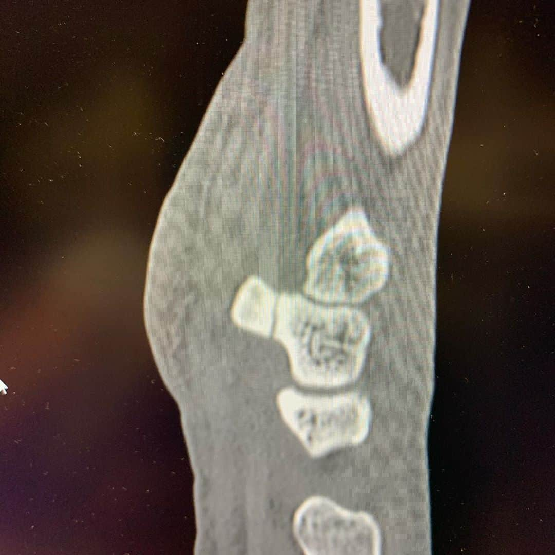 立岡宗一郎さんのインスタグラム写真 - (立岡宗一郎Instagram)「有鈎骨。折れた骨片を摘出する手術を受けます。こわいこわい😱😱 #有鈎骨#局部麻酔#日帰り手術#初手術」3月2日 21時53分 - ta_pi_39