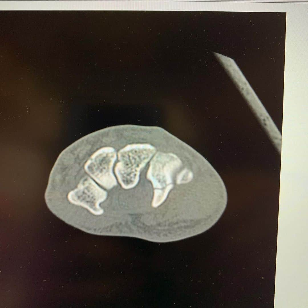 立岡宗一郎のインスタグラム：「有鈎骨。折れた骨片を摘出する手術を受けます。こわいこわい😱😱 #有鈎骨#局部麻酔#日帰り手術#初手術」