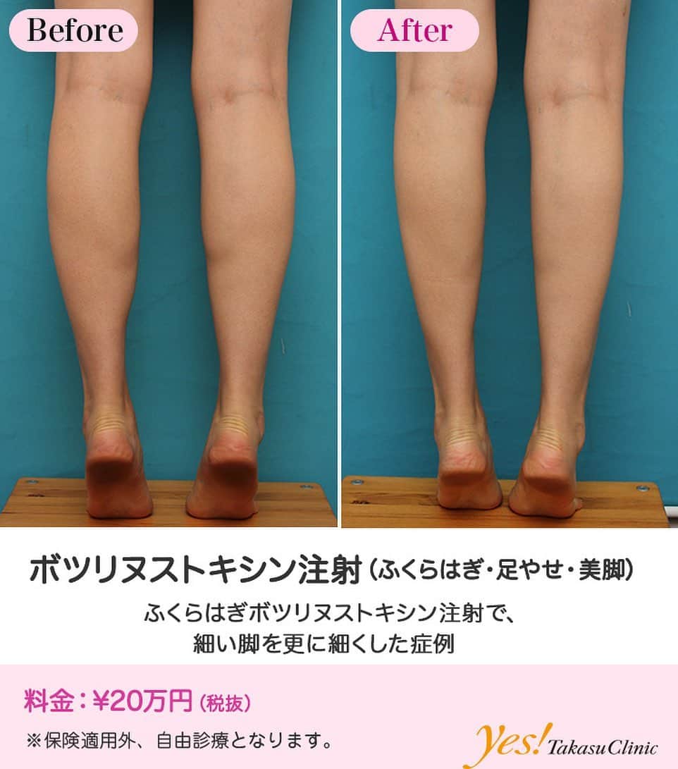 高須クリニックさんのインスタグラム写真 高須クリニックinstagram 高須幹弥医師からのコメント 代女性の患者様で ふくらはぎを細くしたいというご要望でした 診察させていただいたところ ふくらはぎは特別太いほうではなく むしろ 日本人の