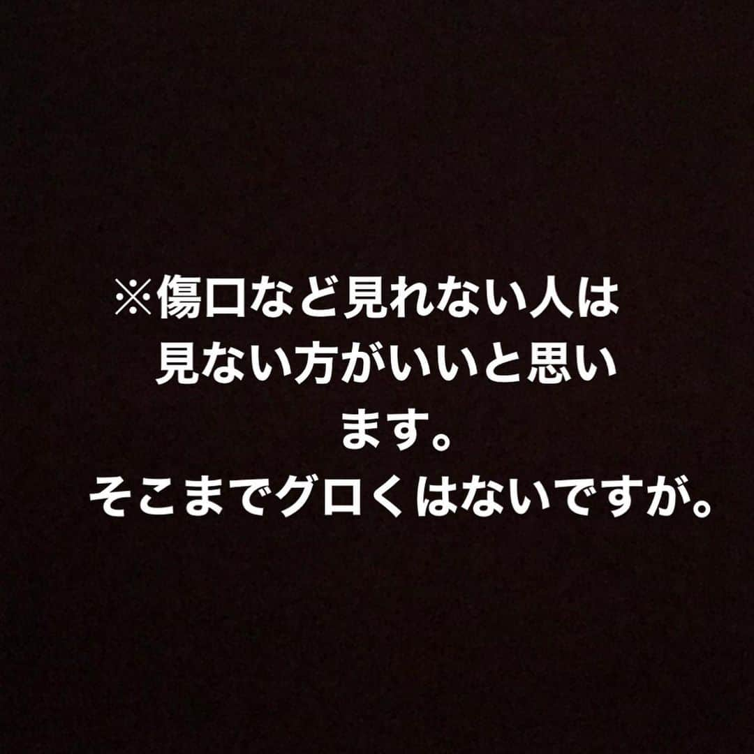 東克樹さんのインスタグラム写真 - (東克樹Instagram)「傷口が塞いだので、治癒促進のため超音波治療を始めました。 #経過報告」3月3日 17時04分 - katsuki1995