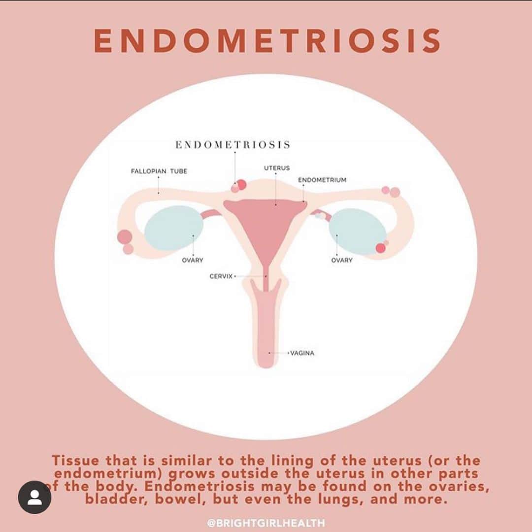マデリン・グローヴスのインスタグラム：「March is Endometriosis Awareness Month 🌟 I have endometriosis and adenomyosis, managing these illnesses is a fkn battle but the support around me makes me feel like I’m winning. This month I’ll be sharing info about endo and related illnesses, some of the great work @qendoau does, my fave endo pages and memes as well as how endo + adeno has effected me, might even do a Q&A if people are interested 🤗  1 in 10 women WORLDWIDE are effected by endometriosis and it’s widely regarded as one of the most painful medical conditions. Despite this it’s still a relatively unknown condition, let’s start to fix that during this important awareness month 💪🏽」