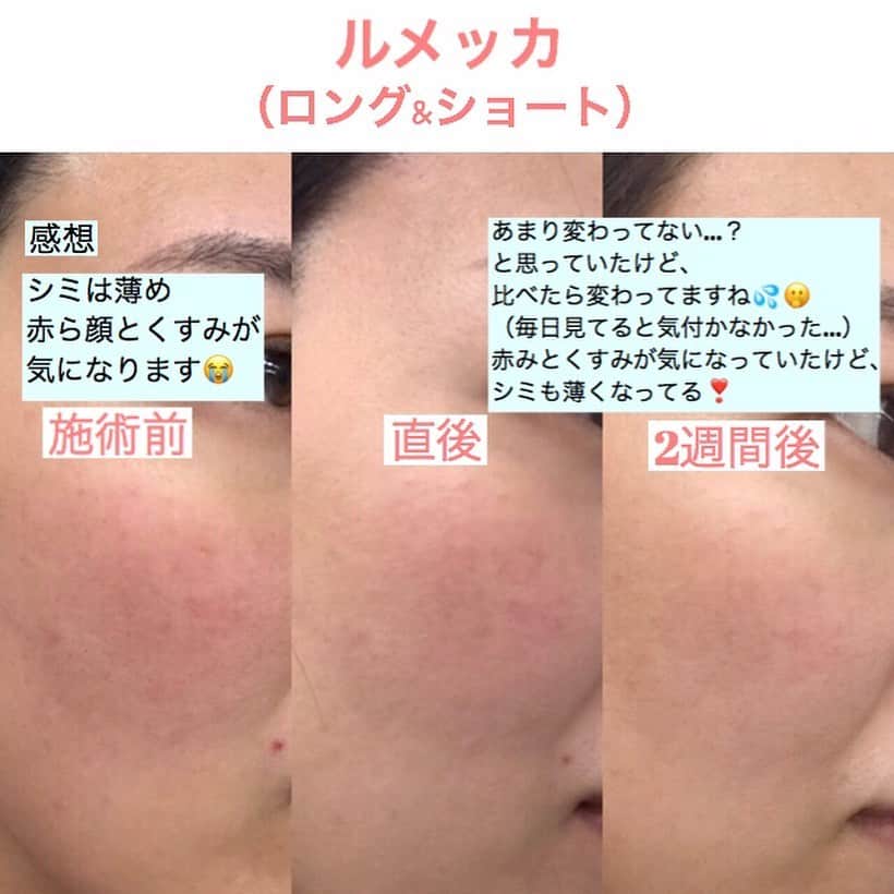 東京美容外科公式さんのインスタグラム写真 - (東京美容外科公式Instagram)「こんにちは、赤坂院です。 花粉症の春の時期ですね！  冬の紫外線対策をサボったり、 スキンケア不足でお肌の悩みはないですか？  この時期にオススメの治療が、 『#しみ 』『#ソバカス 』『#赤ら顔 』『毛穴』等の治療を目的とした、フォトフェイシャル治療器の中ではアメリカＦＤＡ認可製品の最新の治療器 『#ルメッカ 』です ¥20000  多くのフォトフェイシャル（IPL）が 短波長光線域15%程度の効率で照射してますが、ルメッカは短波長光線域を40%に増強する事でメラニン色素を破壊します！！ 今までのIPL治療器で効果がなかった、シミにも1〜2度の治療で効果を出せる事もあります！シミやソバカスや赤ら顔以外にも『ハリ』にも効果があります！！ 写真はスキルアップ講習でルメッカを受けたスタッフの感想です✨ 頬の赤み、くすみを気にしていました。 2週間後、『シミは薄めだからあまり変わってないかなぁ？』と言っておりましたが、条件を合わせて写真を撮ってみると１回の照射で画像の変化がみられました！ ⚠️一時的にシミが濃くなることもございます ⚠️赤みやほてり ⚠️ゴムで弾いたような痛み ⚠️紫外線対策必須  是非、是非、紫外線が強くなる前にお試し下さい 。 ※新型コロナウイルスによる混乱が続いてますが、当院はハンドソープによる徹底した手洗い、消毒液による手指消毒をスタッフ全員がこまめに行っております。 ==🎁お問い合わせはこちら🎁==== 詳しくはプロフィールのURLから公式サイトへ♪ ▼フリーダイヤル 0120-658-958 （コールセンター受付時間：9：00～21：00） ▼LINE予約 @ tkc110 ============== #東京美容外科 #東京美容外科赤坂院 #審美 #美容整形 #きれい #整形 #美活 #綺麗になりたい #美肌 #美意識  #美容外科 #プチ整形 #インビザライン#アンチエイジング #美容好き #歯科ドッグ #美容整形外科 #二重 #埋没法 #タルミ #小顔 #目の下のくま #涙袋 #ルメッカ #ipl」3月6日 17時41分 - tokyobiyougeka_jimukyoku
