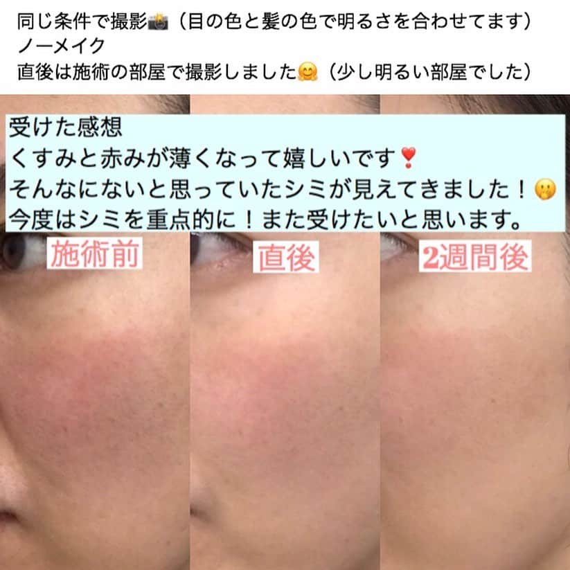 東京美容外科公式さんのインスタグラム写真 - (東京美容外科公式Instagram)「こんにちは、赤坂院です。 花粉症の春の時期ですね！  冬の紫外線対策をサボったり、 スキンケア不足でお肌の悩みはないですか？  この時期にオススメの治療が、 『#しみ 』『#ソバカス 』『#赤ら顔 』『毛穴』等の治療を目的とした、フォトフェイシャル治療器の中ではアメリカＦＤＡ認可製品の最新の治療器 『#ルメッカ 』です ¥20000  多くのフォトフェイシャル（IPL）が 短波長光線域15%程度の効率で照射してますが、ルメッカは短波長光線域を40%に増強する事でメラニン色素を破壊します！！ 今までのIPL治療器で効果がなかった、シミにも1〜2度の治療で効果を出せる事もあります！シミやソバカスや赤ら顔以外にも『ハリ』にも効果があります！！ 写真はスキルアップ講習でルメッカを受けたスタッフの感想です✨ 頬の赤み、くすみを気にしていました。 2週間後、『シミは薄めだからあまり変わってないかなぁ？』と言っておりましたが、条件を合わせて写真を撮ってみると１回の照射で画像の変化がみられました！ ⚠️一時的にシミが濃くなることもございます ⚠️赤みやほてり ⚠️ゴムで弾いたような痛み ⚠️紫外線対策必須  是非、是非、紫外線が強くなる前にお試し下さい 。 ※新型コロナウイルスによる混乱が続いてますが、当院はハンドソープによる徹底した手洗い、消毒液による手指消毒をスタッフ全員がこまめに行っております。 ==🎁お問い合わせはこちら🎁==== 詳しくはプロフィールのURLから公式サイトへ♪ ▼フリーダイヤル 0120-658-958 （コールセンター受付時間：9：00～21：00） ▼LINE予約 @ tkc110 ============== #東京美容外科 #東京美容外科赤坂院 #審美 #美容整形 #きれい #整形 #美活 #綺麗になりたい #美肌 #美意識  #美容外科 #プチ整形 #インビザライン#アンチエイジング #美容好き #歯科ドッグ #美容整形外科 #二重 #埋没法 #タルミ #小顔 #目の下のくま #涙袋 #ルメッカ #ipl」3月6日 17時41分 - tokyobiyougeka_jimukyoku