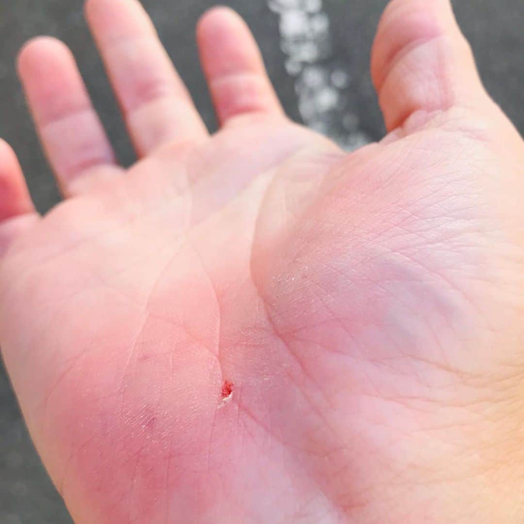 のインスタグラム：「次男と遊んでたら、、、、 ヒリヒリ💦💦💦 久しぶりに転びました😢  #ママ泣いてるの？だって、、、 ないてないから😢」