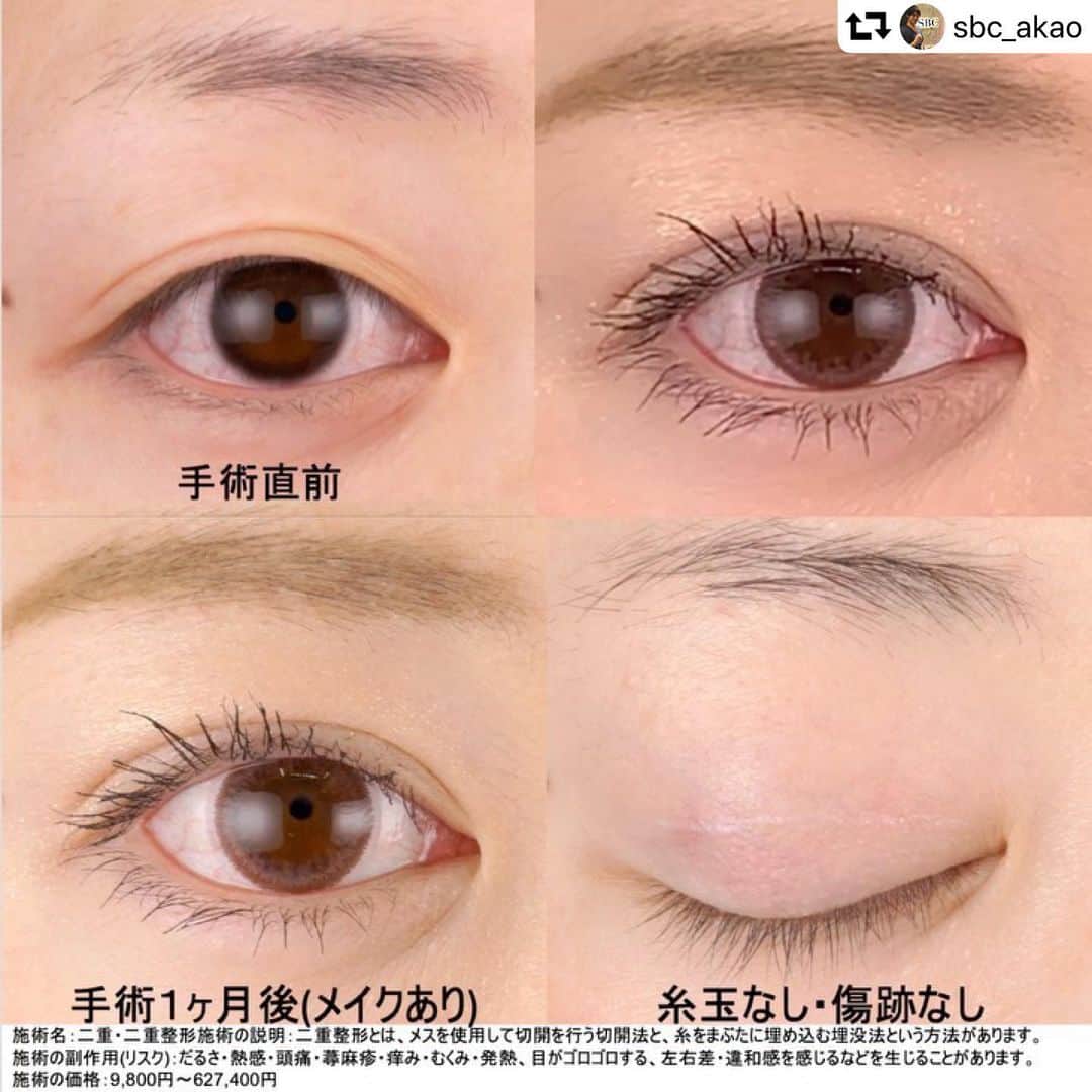 湘南美容外科 柏院さんのインスタグラム写真 湘南美容外科 柏院instagram 切開系の施術でよく耳にする Md式切開法 今日はmd式切開法についてご紹介します Md式切開法って何 ミニマムダウンタイム切開法の略です 2枚目の画像通り 術式や