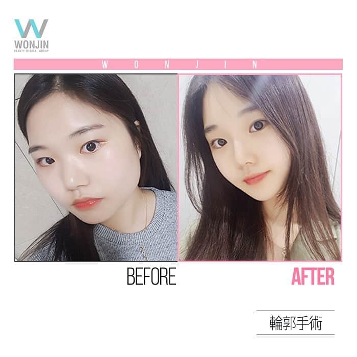 ウォンジン美容整形外科 皮膚科さんのインスタグラム写真 ウォンジン美容整形外科 皮膚科instagram ウォンジン整形外科 輪郭手術リアルビフォーアフター 韓国に来なくても Line上でのオンラインカウンセリング可能 お悩み部位 希望手術