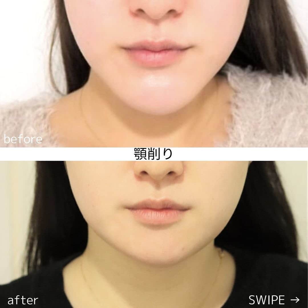 のインスタグラム：「骨格から美しく、魅力的なフェイスラインへ👨‍⚕️👩‍⚕️💉﻿ ﻿ ＼究極の輪郭形成  顎削り／﻿ ﻿ 👨‍⚕️執刀医:ヨシタネ　 @yoshitane_isea .﻿ ﻿ ☑︎顎が長い﻿ ☑︎顎が出てる﻿ ☑︎顎が角ばっている﻿ ﻿ 方にオススメ⭐️﻿ ﻿ ﻿ 【イセアの骨切りは】﻿ ①執刀医と麻酔科医の2名体制﻿ ②形成専門医が担当﻿ ③24H電話対応が可能﻿ ﻿ 1泊入院の場合も看護師2名が経過をサポート👩🏻‍⚕️ 医師も近くで待機しておりますのでご安心ください☺️🏥﻿ ﻿ 骨削りは他施術よりもダウンタイムは﻿ 長くかかりますが😩💦﻿ 輪郭形成の根本的治療の１つです⭐️﻿ ﻿ ▼▼▼▼▼▼▼▼▼▼﻿ ﻿ 写真上:before ﻿ 写真下:after 3ヶ月﻿ ﻿ ﻿ 😣後の痛み: 2〜4週﻿ ⚠️腫れ・内出血: 2〜3週﻿ ⚠️痺れ・知覚麻痺: 6〜12ヶ月程度﻿ 👛¥1035000＋税﻿  カウンセリングは無料です💁🏼‍♀️💁🏼‍♂️﻿ お気軽にご来院下さい👩🏻‍⚕️️✨﻿ ﻿ ﻿ #銀座#ginza ﻿ #iseaclinic#イセアクリニック﻿ #美容整形#美容外科#美容皮膚科﻿ #吉種克之 ﻿ #プチ整形#輪郭整形#輪郭#骨削り#アゴ削り﻿ #小顔#小顔矯正﻿ #アンチエイジング#若返り﻿ #綺麗になりたい#可愛くなりたい」