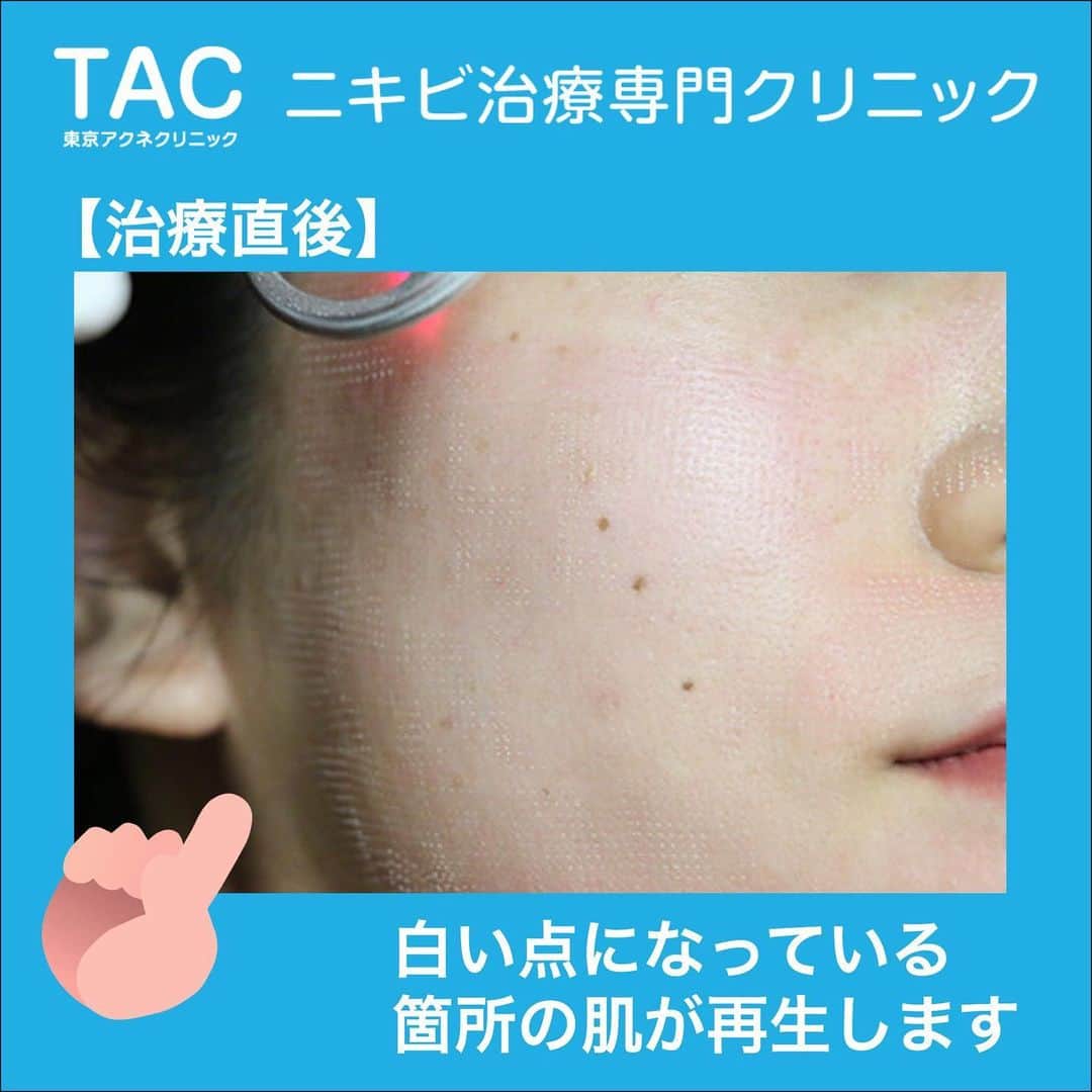 東京アクネクリニックさんのインスタグラム写真 - (東京アクネクリニックInstagram)「～『フラクショナルレーザー』でお肌の入れ替え～﻿ ﻿ 東京アクネクリニックの『フラクショナルレーザー』は、﻿ レーザーで皮膚に多数の穴を開けることでお肌の再生を促し、ニキビ跡やクレーターを改善してくれる施術です😌﻿ ﻿ 麻酔をしてから施術を行うので、痛みは強くはありません。﻿ ダウンタイムは1週間〜10日ほどですが、翌日からメイクも可能です。﻿ ﻿ お顔全体にも照射できますが、気になる部分だけでもOK🍓﻿ ﻿ ✔️ニキビ跡﻿ ✔️毛穴の開き﻿ ✔️クレーター肌﻿ ﻿ にお悩みの方にオススメです💎﻿ ﻿ 【料金】﻿ トライアル　部分1回　5,000円＋税﻿ 全顔　1回　20,000円+税﻿ 部分（5cm×5cm）1回　9,000円＋税﻿ ﻿ ﻿ ▼フラクショナルレーザーに関する﻿ お問い合わせは下記まで▼ ﻿ +:-:+:-:+:-:+:-:+:-:+:-:+:-:+:-:+:-:+﻿ ﻿ 🌱東京アクネクリニック🌱﻿ ﻿ 📲フリーダイヤル　0120-90-5541﻿ ※コールセンター受付時間 9:00～21：00﻿ ﻿ お問い合わせはプロフィールのURLから💻 ﻿ +:-:+:-:+:-:+:-:+:-:+:-:+:-:+:-:+:-:+﻿ ﻿ #ニキビ #大人ニキビ #吹き出物 #ニキビ跡 #ニキビ肌改善 #ニキビ治療 #肌荒れ #ニキビケア  #肌荒れ改善 #美肌治療 #美肌 #美肌ケア #美容皮膚科 #皮膚科 #エステ #ピーリング #肌質改善 #すっぴん #スキンケア #ニキビ予防﻿ #赤ニキビ　#黒ニキビ　#黄ニキビ #ニキビ治療専門　#フラクショナルレーザー  #クレーター肌 #いちご鼻 #毛穴」3月12日 11時49分 - nikibi.c