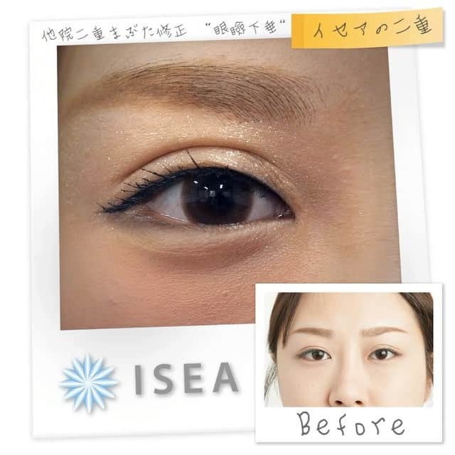 のインスタグラム：「「目つきが悪い」「眠たそうな目」なんて言われたことはないですか⁉️ * もしかしたらその現象、眼瞼下垂かも…💦💦 * 🌱眼瞼下垂術体験動画🌱 👉https://youtu.be/LRIHuV6GmYc 🌱眼瞼下垂について🌱 👉http://www.tokyoisea.com/plastic-surgery/ganken/ * * #世界で一番愛される私に  #イセアクリニック#iseaclinic #二重#埋没#眼瞼下垂 #ふたえ#メイク#涙袋 #二重になりたい #可愛くなりたい #メザイク#アイプチ #followme#instalike」
