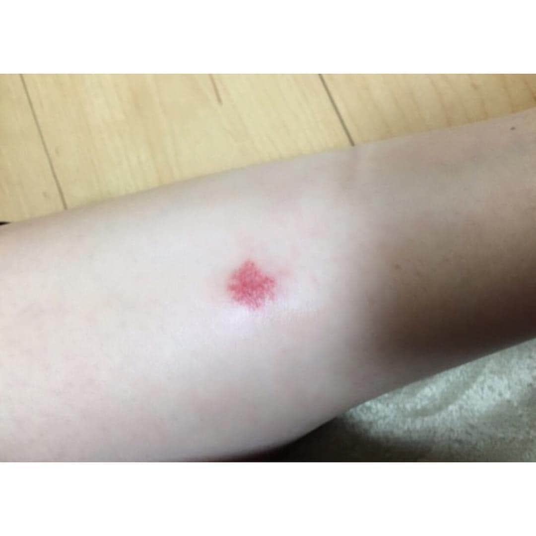 今野鮎莉さんのインスタグラム写真 - (今野鮎莉Instagram)「このあいだの撮影で原因不明の変な虫に刺され、  撮影の日から毎日、ずーっと痒いという  酷な日々を送ってる今野鮎莉です笑」7月4日 12時38分 - ayurikonno