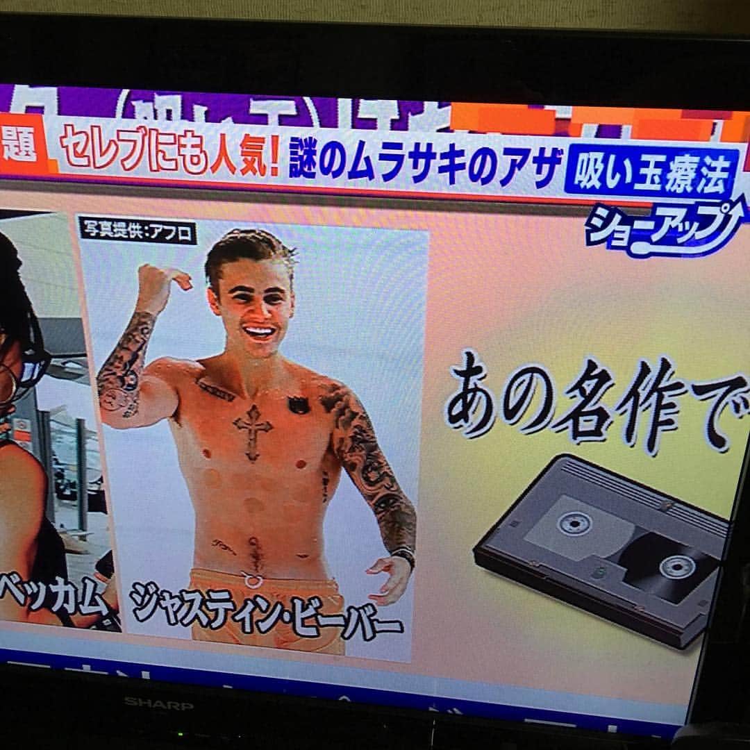 森田繁のインスタグラム：「米国の水泳選手で話題のカッピングって、３０年くらい前にプロレスラーの間で流行してマスコミでもよく取り上げられていたので、今更感があるなー。猪木の背中にもあったもんね。」