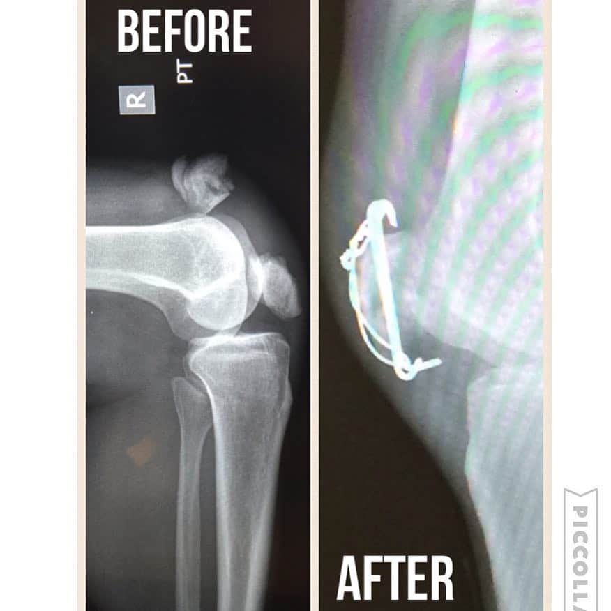 ペニー・クームズさんのインスタグラム写真 - (ペニー・クームズInstagram)「Here's a picture of what my knee looked like after my fall🙈, and 4 weeks post surgery 💉! I wonder what it will look like in my CT scan next week?💪🏻👌🏻 #CTScanCountDown #4DaysToGo」8月29日 2時57分 - pennycoomes