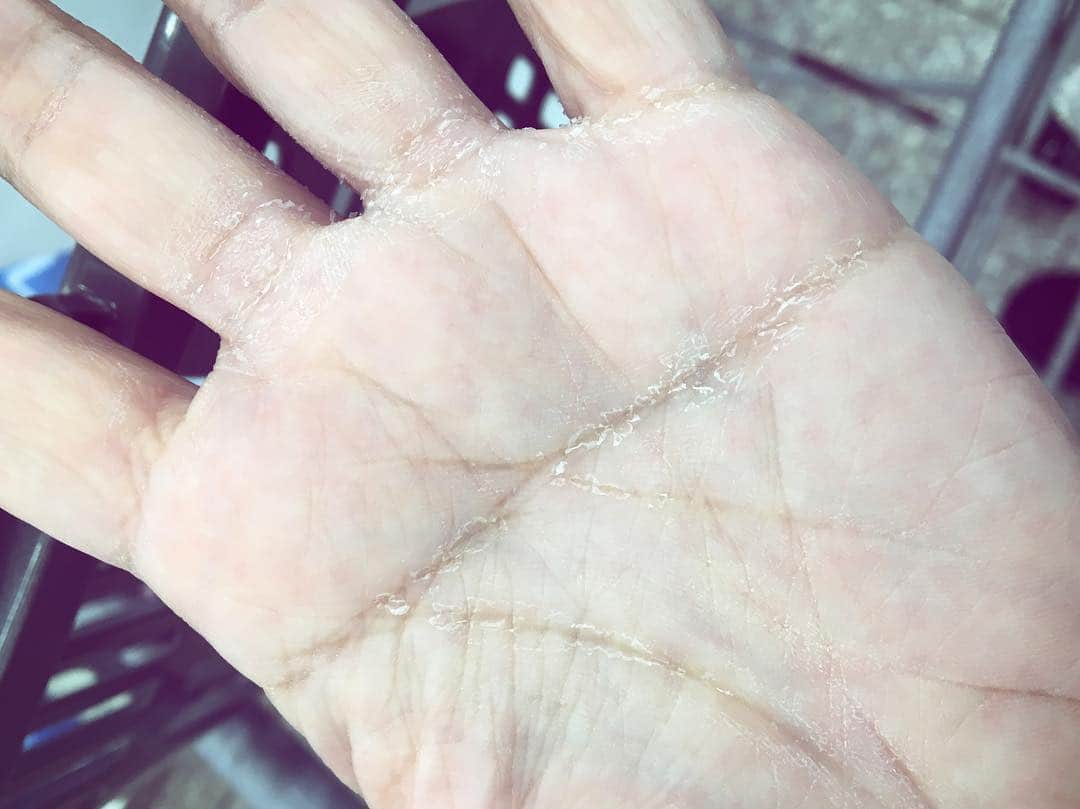 バイリンガル3兄妹さんのインスタグラム写真 - (バイリンガル3兄妹Instagram)「手洗い、ハイター、エタノール。 ・ この1週間で5歳は老けたわたしの手。 ・ #ガッサガサ #皮むけまくり #手相に沿ってむけてる #アデノウイルス  #回復に向かってます」2月20日 14時06分 - yucgram