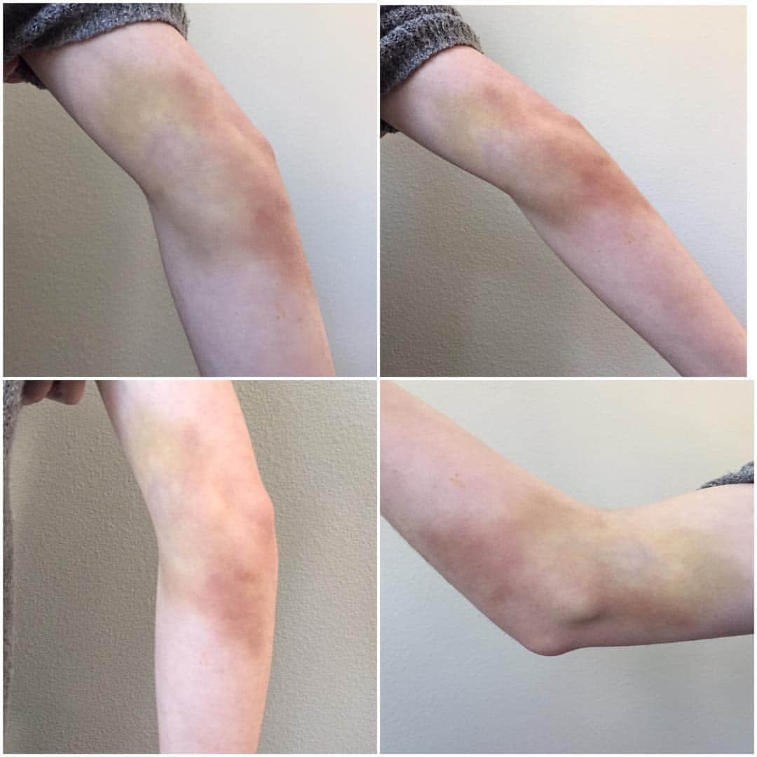 マッケンジー・フォイさんのインスタグラム写真 - (マッケンジー・フォイInstagram)「Falling technique in Tae Kwon Do + archery + my clumsiness + a trampoline park = this glorious bruise!!! It doesn't hurt it just looks colorful! 😁」3月2日 3時50分 - mackenziefoy