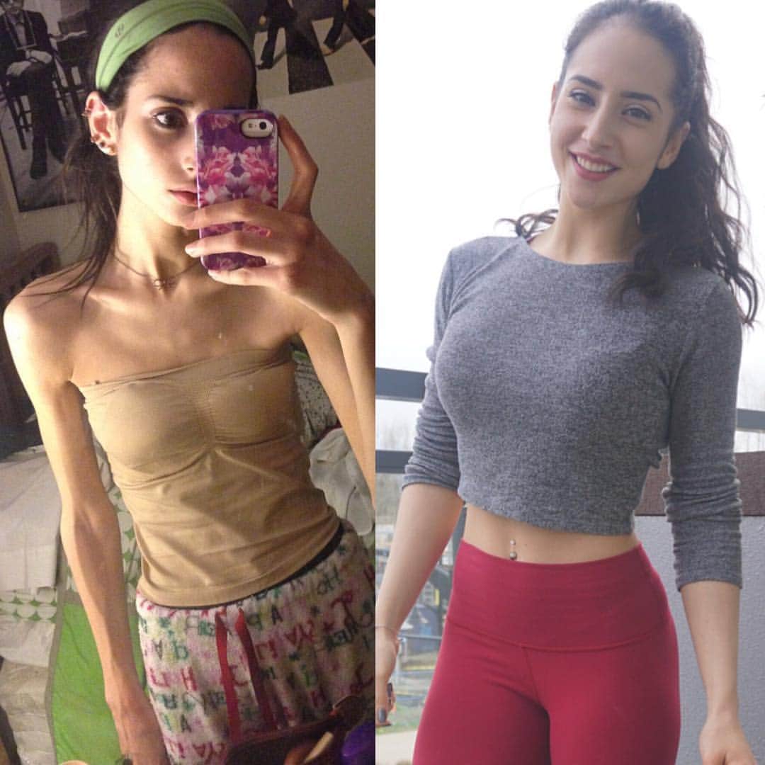 Sarah Ramadanさんのインスタグラム写真 - (Sarah RamadanInstagram)「Believe it or not, both of these women are me.  On the left I was a month into my recovery journey. It was a month of unfolding, of realizing that no matter what I weighed or what I ate, healing my symptoms could never cure my suffering. It was a month of learning more about me, and more about the body that took on the burden of anorexia for 4 years too many.  It was a month of exhaustion. I will never forget it.  And what may shock you even more than these photos, or the tales of my past, is this:  I love who I am now, but I also loved who I was then.  That woman on the left decided to fight against an illness no matter the cost. Without antagonizing her skin and resenting her reflection, she was thankful. She was thankful for her body, pushing her into existence no matter her neglect. She was thankful for her heart for never skipping a beat, no matter how worn out it was. She was thankful for opportunity, no matter how distant it might be.  Simply put, gratitude was a catalyst to my self love.  Self-love has to start somewhere, anywhere. You can’t resent where you stand and expect that you will situate yourself in acceptance down the road. You can’t wait for perfect moments that aren’t coming. You can’t wait for material, or love from another. You cannot regret and simultaneously embrace gratitude.  Above all,  you cannot hate your way to self love.  I sure as hell could not afford waiting. I suggest you don’t either.  Love where you stand — it is the soil that grounds your growth. 💜  #RosesBareThorns #SelfLoveInAction #FightForGrowth」4月15日 9時15分 - fightforgrowth