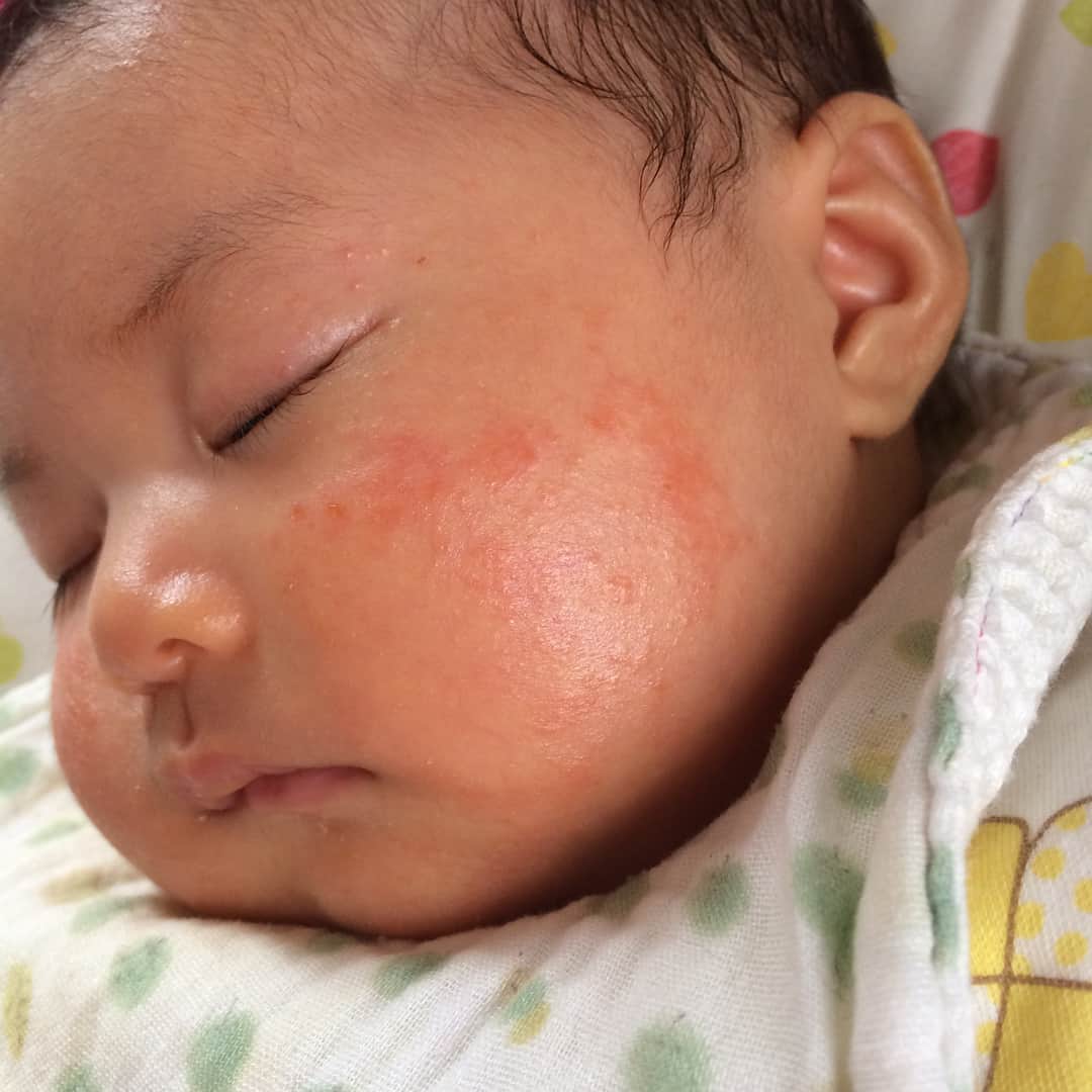 浅川稚広さんのインスタグラム写真 浅川稚広instagram 乳児湿疹 徐々に回復中 ヒルドイドローション ワセリン ステロイドは使いたくない 6月13日 17時00分 Chiffy1110