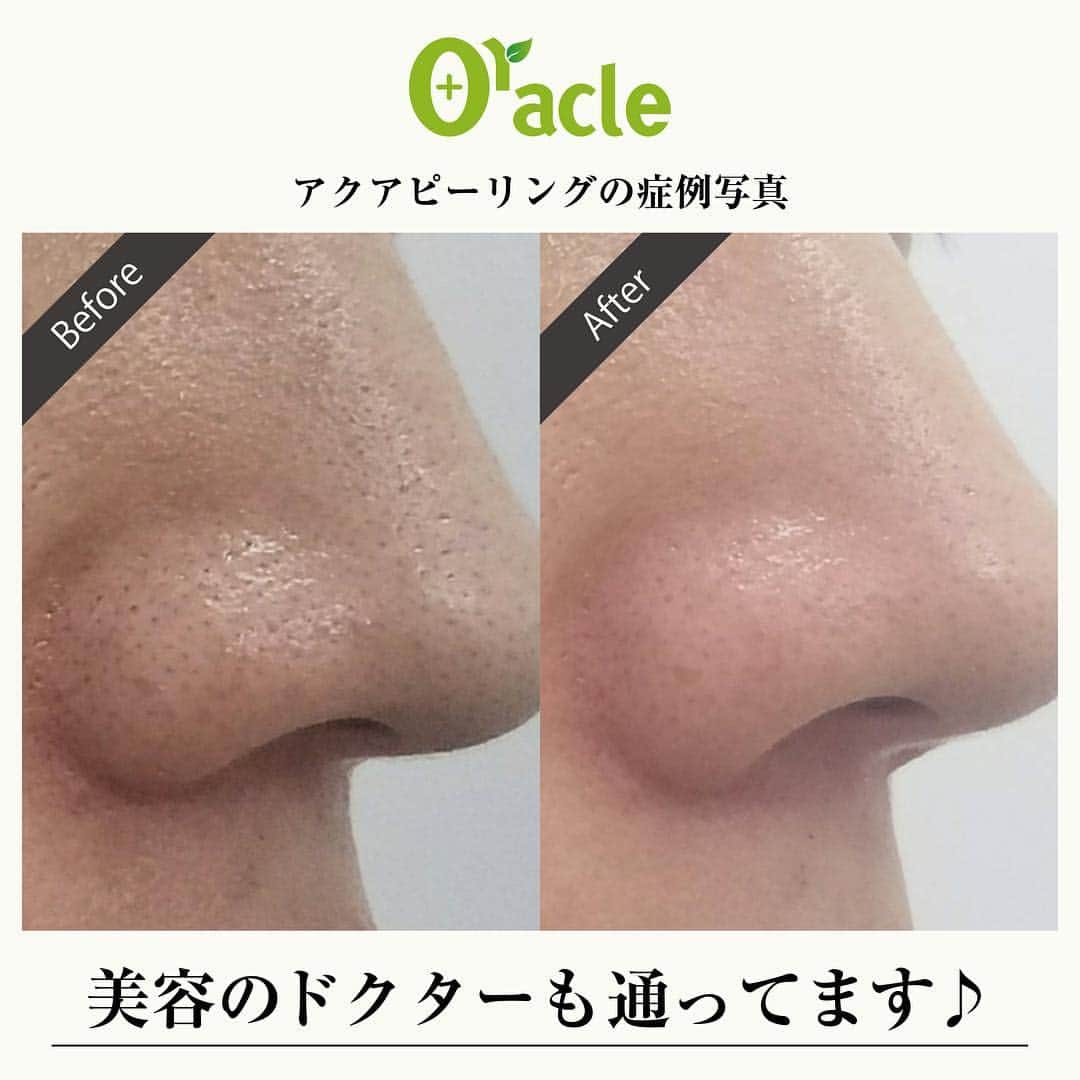 オラクル美容皮膚科東京新宿院さんのインスタグラム写真 - (オラクル美容皮膚科東京新宿院Instagram)「🍀美容のドクターが通うクリニック『オラクル美容皮膚科』🍀 . その秘密は、安心の技術と治療効果にあり‼️ .　 そこで、実際にドクターが施術を受けたアクアピーリングの症例写真をご紹介します🌟♪( ´▽｀) .  アクアピーリングとは、水分を与えながら毛穴の角栓や汚れなどを吸引していく施術方法🎵 専用の機器を使用して鼻やTゾーンの汚れを吸引後、美容液でお肌に栄養を与え、整えていきます❤️ .　 施術前と比べて鼻のデコボコや黒ずみなどが無くなり、ツルツルしたお肌に生まれ変わりました！！🌻 .  オラクル美容皮膚科は、これまでの多数の症例・経験を元に、それぞれの患者さまに最も効果的と思われる方法・技術を組み合わせて治療を行います✨ .　 世界基準の医療サービスを、ぜひご自身のお肌で実感してみてください🌟 . ☆ーー☆ーー☆ーー☆ーー☆ーー☆ーー☆ 【オラクル美容皮膚科】 http://www.oracleclinic.jp/ フリーダイヤル ☎0120-905-696 コールセンター 受付時間 9:00～21:00［年中無休］ LINEからもご予約可能です ID：@oracle.jp ☆ーー☆ーー☆ーー☆ーー☆ーー☆ーー☆ . #オラクル #オラクル美容皮膚科 #美容 #皮膚科 #綺麗 #綺麗になりたい #ドクター #治療 #アクアピーリング #鼻 #角栓 #黒ずみ #ブラックヘッド #美白 #美肌 #水分 #毛穴 #beauty #beautiful #oracle #followmefollow #instalike」8月2日 19時16分 - oraclejp