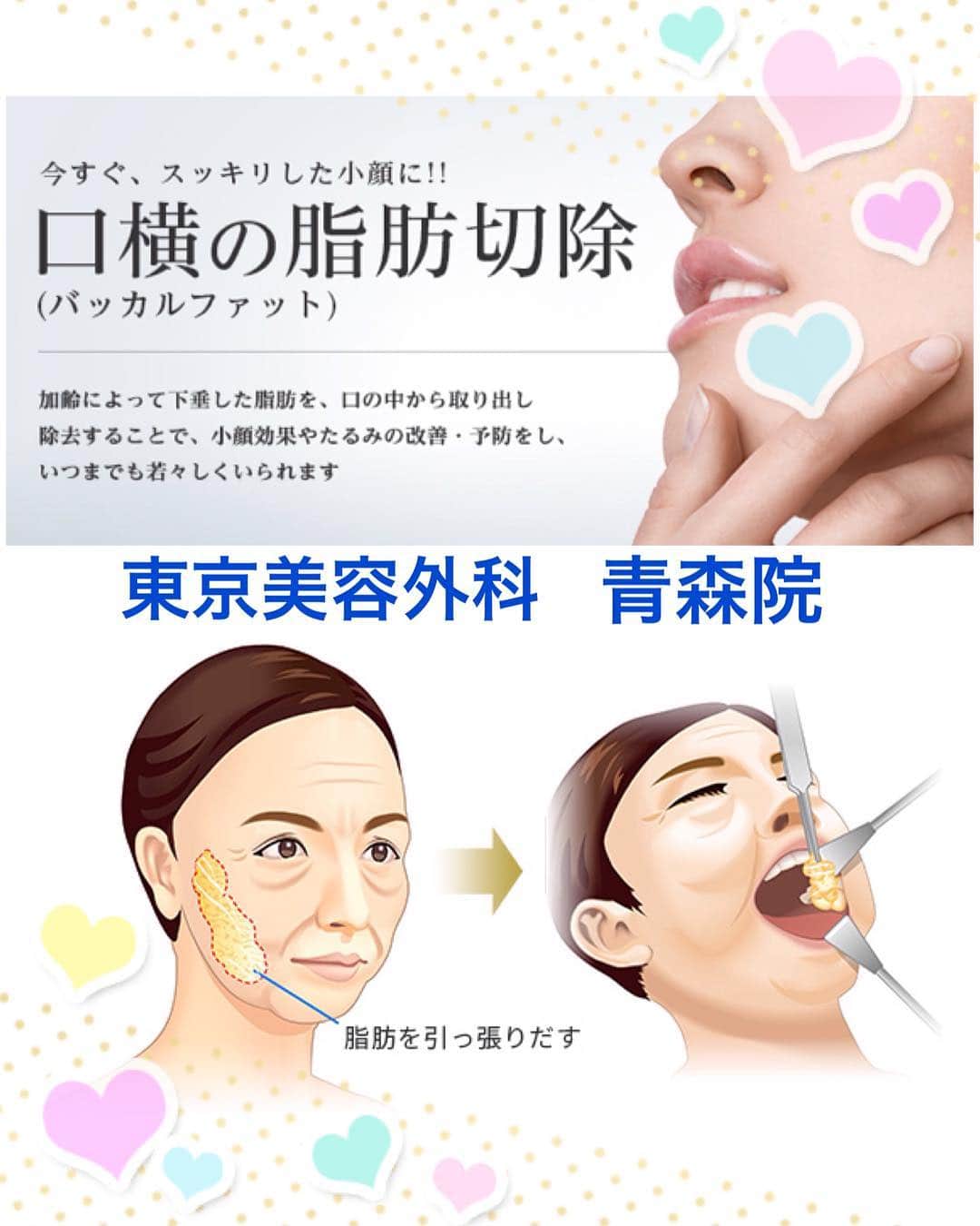 東京美容外科公式さんのインスタグラム写真 - (東京美容外科公式Instagram)「. 頬の中央部の深いところにある脂肪の塊は 若いうちは高い位置にありますが 加齢とともに下垂したるみや法令線の 原因となってしまいます💦 . この脂肪を除去することで若返りと 小顔の効果があります✨ . また、将来頬がたるんで ブルドッグ顔、下膨れの顔を予防できます💕 . 20代、30代と年齢問わず 人気のある施術になっています😊 . お顔表面に傷が残らないのも 人気理由の１つです❣️ . 東京美容外科で小顔を 手に入れませんか💖？ .  #東京美容外科#東京美容外科青森院#青森院#美意識#美肌#女子力#綺麗#痩せたい#ダイエット#注射#痩身#脂肪吸引#BNLS#バッカルファット#脂肪#除去#リバウンド#ダウンタイム#二重#アイプチ#さよなら#豊胸#ヒアルロン酸#夏#青森#青森県#クリニック#美容#アンチエイジング#メンテナンス」8月9日 10時41分 - tokyobiyougeka_jimukyoku