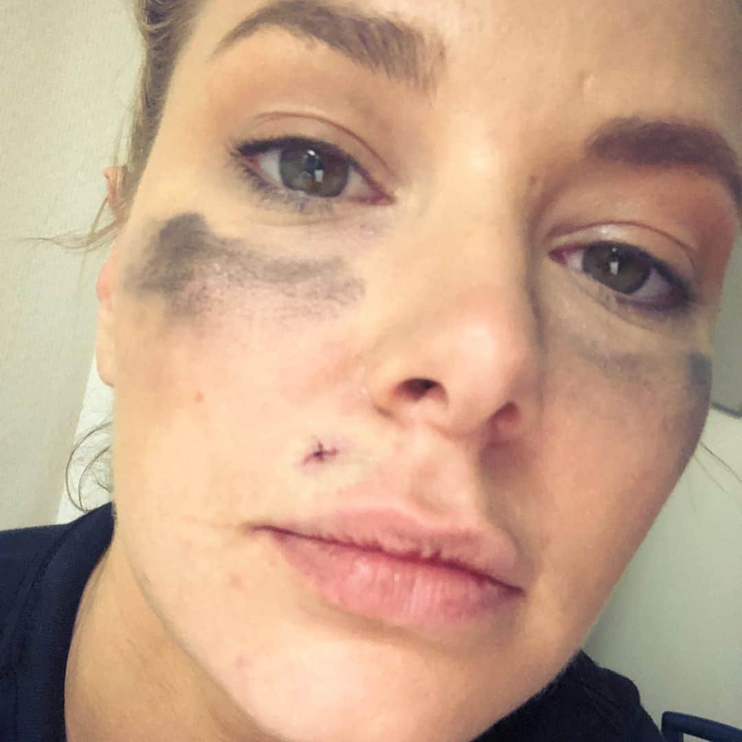 アリアナ・マディックスさんのインスタグラム写真 - (アリアナ・マディックスInstagram)「we may have lost the game, but we won in number of white claws consumed ✨ a trip to the ER and two stitches later (one inside and one outside bc my tooth went through my lip sorry tmi), i’m just glad someone caught it on video 😂 i’m SO LUCKY 😬✨ #teamtomtom #notacheapaccident #canimakebravopayforit #pumprules *ps- i’m obsessed with this pic of me and @jeremymadix havin fun!*」4月30日 4時02分 - arianamadix