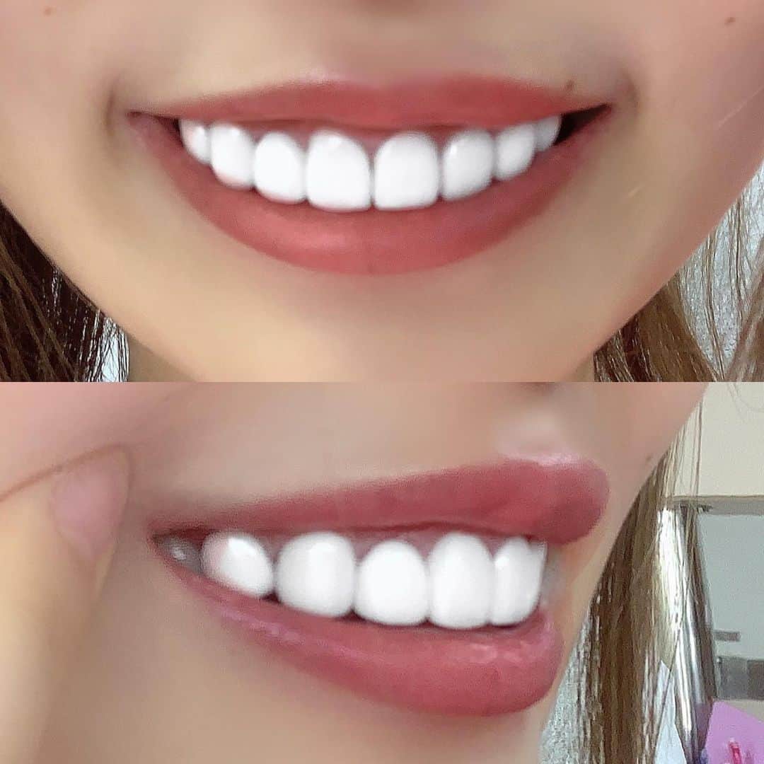 黒宮ちはやさんのインスタグラム写真 - (黒宮ちはやInstagram)「セラミック紹介👄✨ " #ホワイトホワイト "ルミネ新宿店の 石井院長先生に施術してもらいました⭐️ . 元々前歯の歯並びが悪くて 八重歯があったり歯も大きかったのが コンプレックスで💔 山田涼介くんの歯の写真を見せて、 歯が小さめでスマイルラインがある 可愛らしいデザインにしてください！ ってお願いしました🤣💖 完璧なデザインすぎる！！！ . 上の前歯から8本 #セラミック 下は #ホワイトニング  気になる方は是非💖  #黒宮ちはや #CELUX #セリュックス」4月30日 16時12分 - chihaya_kuromiya