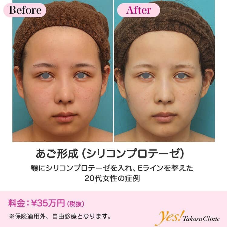 高須クリニックさんのインスタグラム写真 - (高須クリニックInstagram)「👨🏻‍⚕️高須幹弥医師からのコメント✨⠀ 20代女性の患者様で、顎がないのが悩みということで来院されました。 診察させていただいたところ、下顎の骨が小さいため、縦に短く、後ろにも引っ込んでいました。 口元はそれほど出ていませんでした。 顎が小さく引っ込んでいるため、正面から見たときの輪郭、フェイスラインのバランスが悪く、横から見たときのEラインのバランスも悪い状態でした。 シリコンプロテーゼか、顎専用の硬さのある長期持続型ヒアルロン酸注射のどちらかで顎を出すことをご提案したところ、患者様は永久的な効果のある治療をご希望されたため、シリコンプロテーゼで行うことになりました。 顎先がやや尖り気味にシャープに出るように、約6mmの厚みのシリコンプロテーゼを顎先が斜め下方向に出るように入れました。 手術後は、正面から見たときに程よく顎先が尖ったシャープなフェイスラインになりました。 また、横から見たときに、鼻先と唇と顎先を結んだ線がほぼ一直線になって、Eラインが整いました。 ---------------------------------------------------- 🌈料金✨⠀ ●あご形成（シリコンプロテーゼ） ¥350,000【東京、横浜、名古屋、大阪】 ---------------------------------------------------- ⚠️リスク・副作用・合併症✨⠀ ●あご（顎）形成（シリコンプロテーゼ） 腫れ（術後） 仕上がりのわずかな左右差（完璧なシンメトリーは不可） 仕上がりが完璧に自分の理想の形にならないことがある 感染 --------------------------------------------------- 😊施術についての詳細✨⠀⠀ https://www.takasu.co.jp/photo/ago014.html ---------------------------------------------------- 📞ご予約・お問い合わせ✨⠀ 0120-5587-10⠀ https://www.takasu.co.jp/cgi-bin/form/contact.cgi ※症例写真や施術に関するご質問なども上記までお願い致します。 ---------------------------------------------------- #顎 #顎を出したい #顎がない #顎が欲しい #あご形成 #シリコンプロテーゼ #顎シリコンプロテーゼ #顎整形  #皮膚 #美容 #美肌 #エイジングケア #美容整形 #美容外科 #美容クリニック #美容好き #美容皮膚科 #モニター #モニター募集 #高須クリニック #高須クリニック名古屋 #高須幹弥 #整形したい #プチ整形 #症例 #症例写真 #可愛くなりたい #可愛い #美人」5月1日 19時23分 - takasu_staff