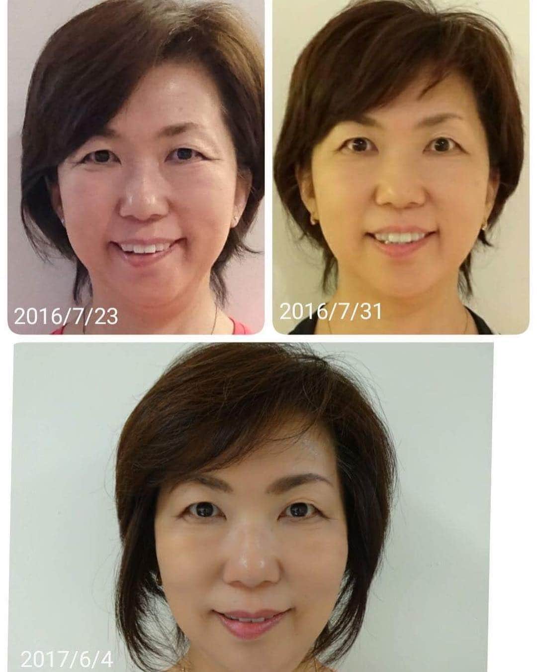 間々田佳子のインスタグラム：「【顔ヨガ効果】 金沢のYさん1週間でお顔スッキリ。1年で5才若返り✨自力で鍛える！大事です！ #間々田佳子 #顔ヨガ #顔ヨガビフォーアフター #美容 #たるみ解消 #むくみ解消 #自力美容 #顔スッキリ」