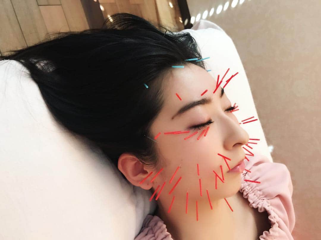 のインスタグラム：「念願の美容鍼灸してきました💓顔に針がたくさん刺さってるΣ(･ω･ﾉ)ﾉすごい✨痛いのかなって思ってたけど少しチクって感じで注射が大嫌いな私でもへっちゃらでした🤗固まってるものがほぐれていく感覚があってスッキリしました😍❣️お店の雰囲気やスタッフの方も優しくて良かったです٩(ˊᗜˋ*)وありがとうございました😊💗 #meilong #恵比寿 #東京 #tokyo #美容鍼灸 #鍼灸 #鍼灸治療 #腰痛 #美容 #小顔 #肩こり #頭痛 #ダイエット #diet #マッサージ #美肌 #beauty #女子力 #girl #me #デトックス #気持ちいい #instagood」