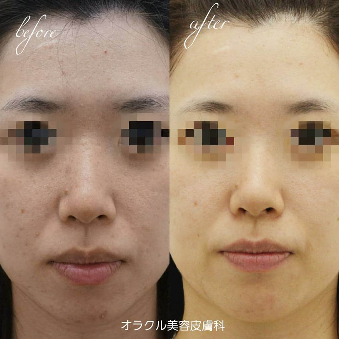 オラクル美容皮膚科東京新宿院さんのインスタグラム写真 - (オラクル美容皮膚科東京新宿院Instagram)「美肌になりたいけど レーザーやピーリングって効果があるの❔❔ と不安をお持ちの方もいらっしゃいますよね😭❗ . こちらの方は実際に #アクアピーリング  #再生管理  #ジェネシス  の治療で美肌になられました🙌💓 . ニキビや肌荒れでお悩みでしたが ピーリングで水分油分バランスを整え、 再生管理で保湿とビタミン補給、 ジェネシスでニキビ跡の赤みとハリを出し 自信をもてるお肌に、、、✨✨ . 治療途中なのでまだまだ美肌になれそうです😍❇ . とにかく美肌になりたい方💓 是非一度オラクル美容皮膚科へお越しください🤗 . . . ☆・‥…━━━☆・‥…━━━☆ . 【オラクル美容皮膚科】 https://www.oracleclinic.jp/ フリーダイヤル ☎0120-905-696 コールセンター 受付時間 9:00～21:00［年中無休］ LINEからもご予約可能です ID：@oracle.jp . ☆・‥…━━━☆・‥…━━━☆ . . . #オラクル美容皮膚科 #オラクル  #oracle #韓国美容 #美容皮膚科  #美肌 #陶器肌 #レーザー  #ピーリング #ニキビ #ニキビ跡  #シミ #色素沈着 #肌荒れ  #オルチャン #保湿 #beauty」10月11日 10時28分 - oraclejp