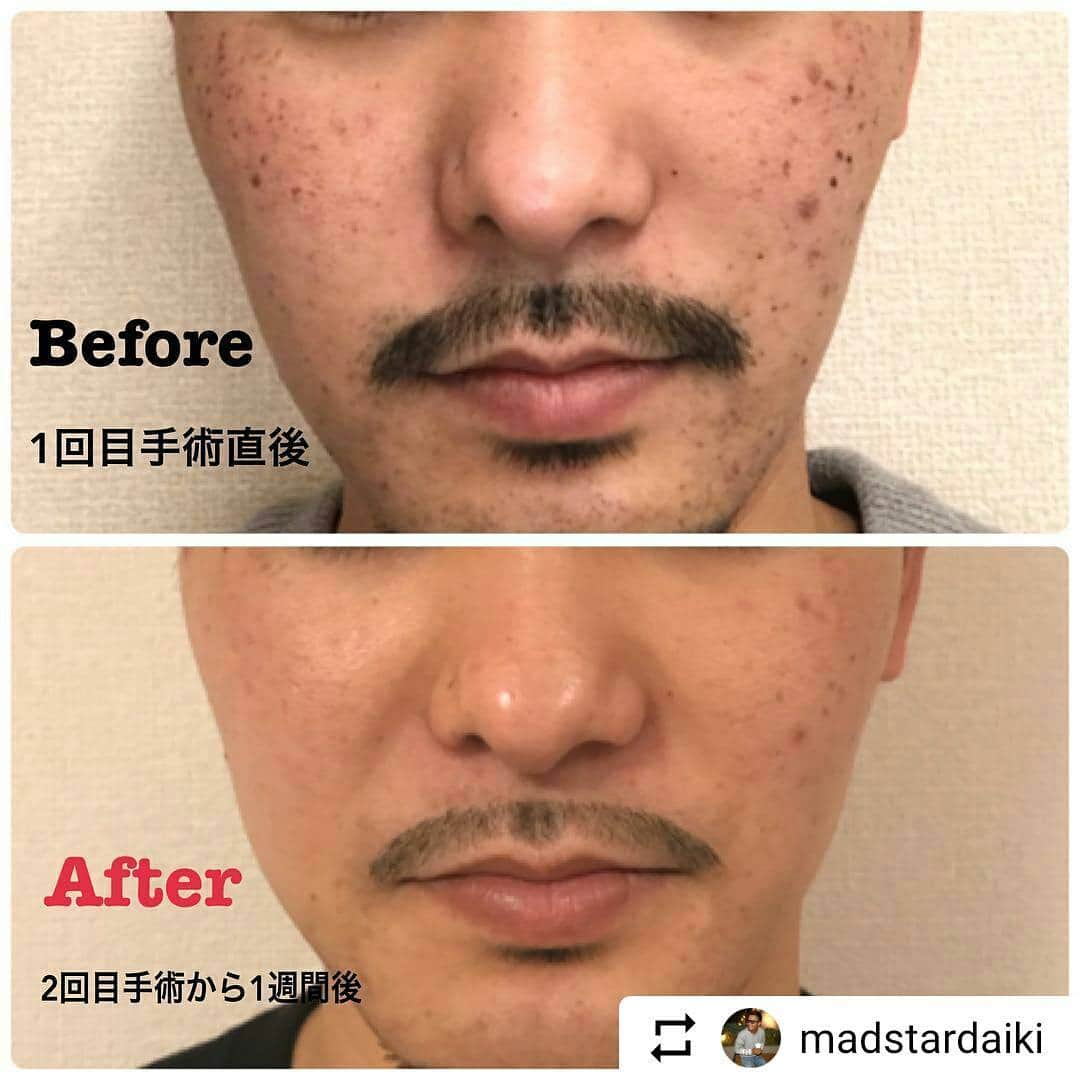 東京美容外科公式さんのインスタグラム写真 - (東京美容外科公式Instagram)「モデルのDAIKIさん、ありがとうございます✴❇ マリンスポーツや日焼けサロンに行かれるかたにもおすすめのIPLレーザー！🌊☀ 男性も美肌の時代ですよー🙆✨ . #東美mens . . #Repost @madstardaiki ・・・ @tkc110.jp にて2回目のIPLレーザー手術を受けてから2週間が経ちます‼︎ ・ 見比べるとハッキリ分かるぐらいシミ、ソバカス、ニキビ、カミソリ負けの跡が無くなって濃い部分も薄くなってきてる😎因みに画像加工全くしてませんよー✨ ・ 日サロを我慢するのは正直辛いけどそれ以上に肌が綺麗になる事が嬉しい😂 ・ メンズも肌が綺麗な方が良いし、モチベーションも変わってくるので気になる人はDM下さい👍✨ ・ DAIKIの紹介で20%割引できるよ👀‼︎ ・ #東京美容外科 #新宿院 #IPLレーザー #シミ悩み #解消 #メンテナンス #メンズ ・ 2回でこれはヤバイ😂 . . #メンズ美容 #メンズ美肌 #日焼け#日サロ #サーフィン #海 #肌荒れ #surf #波 #スキンケア #肌メンテナンス #美肌 #しみ消し #エイジングケア #アンチエイジング #美容 #美容男子 #サーファー」2月6日 17時13分 - tokyobiyougeka_jimukyoku